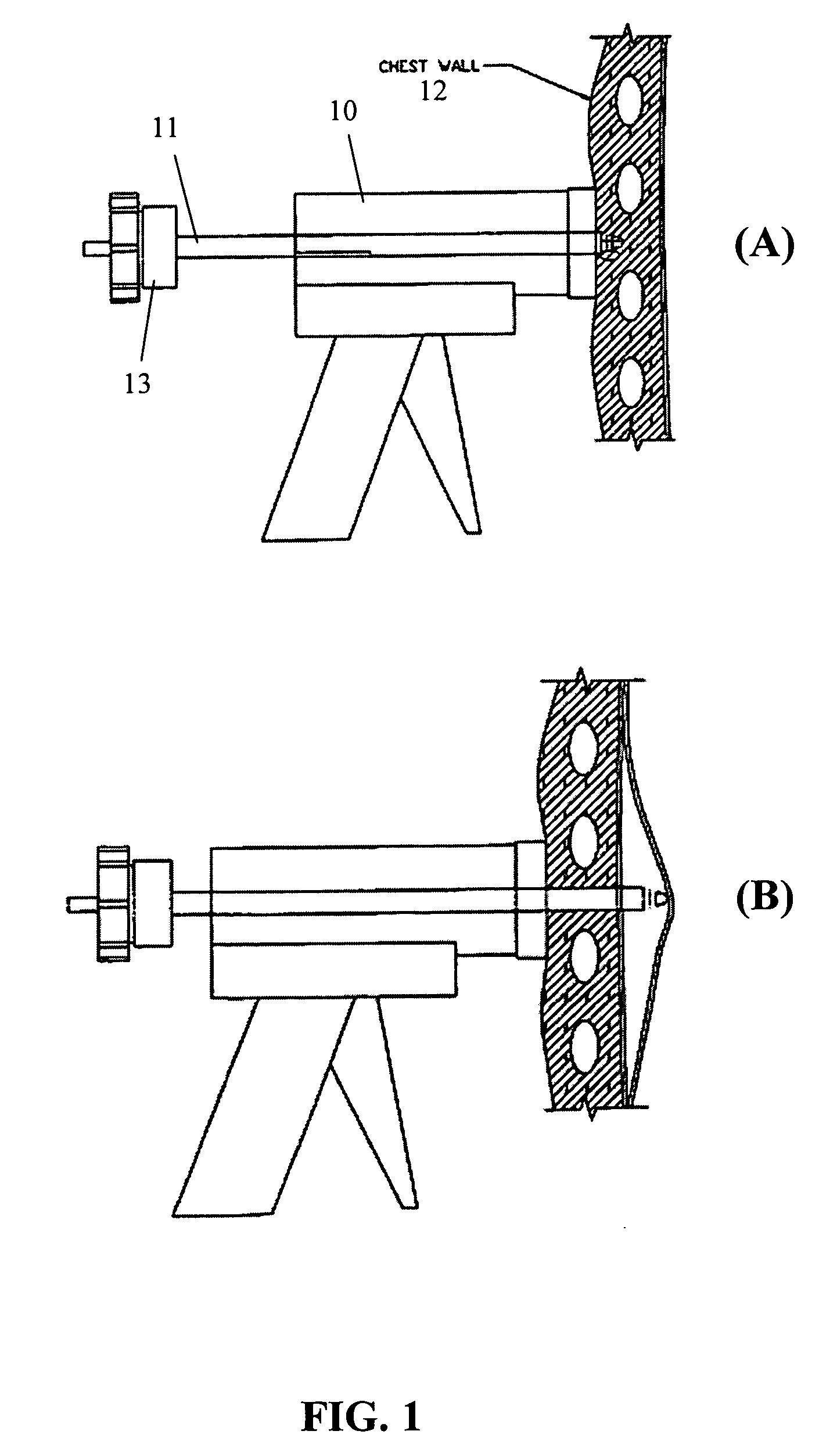 Apparatus and methods for safe and efficient placement of chest tubes