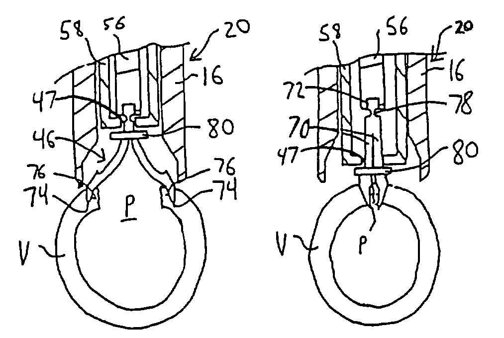 Vascular sheath with bioabsorbable puncture site closure apparatus and methods of use