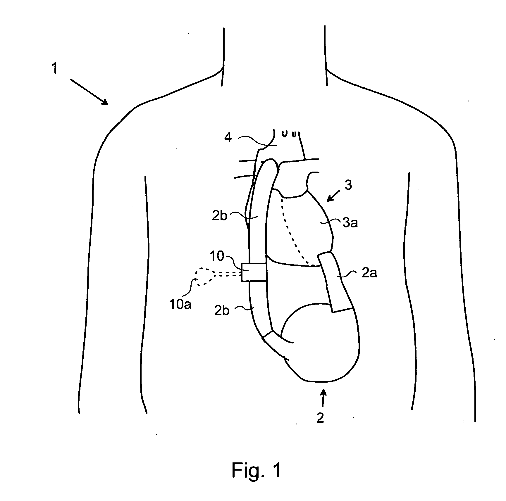 Blood clot removal device, system, and method