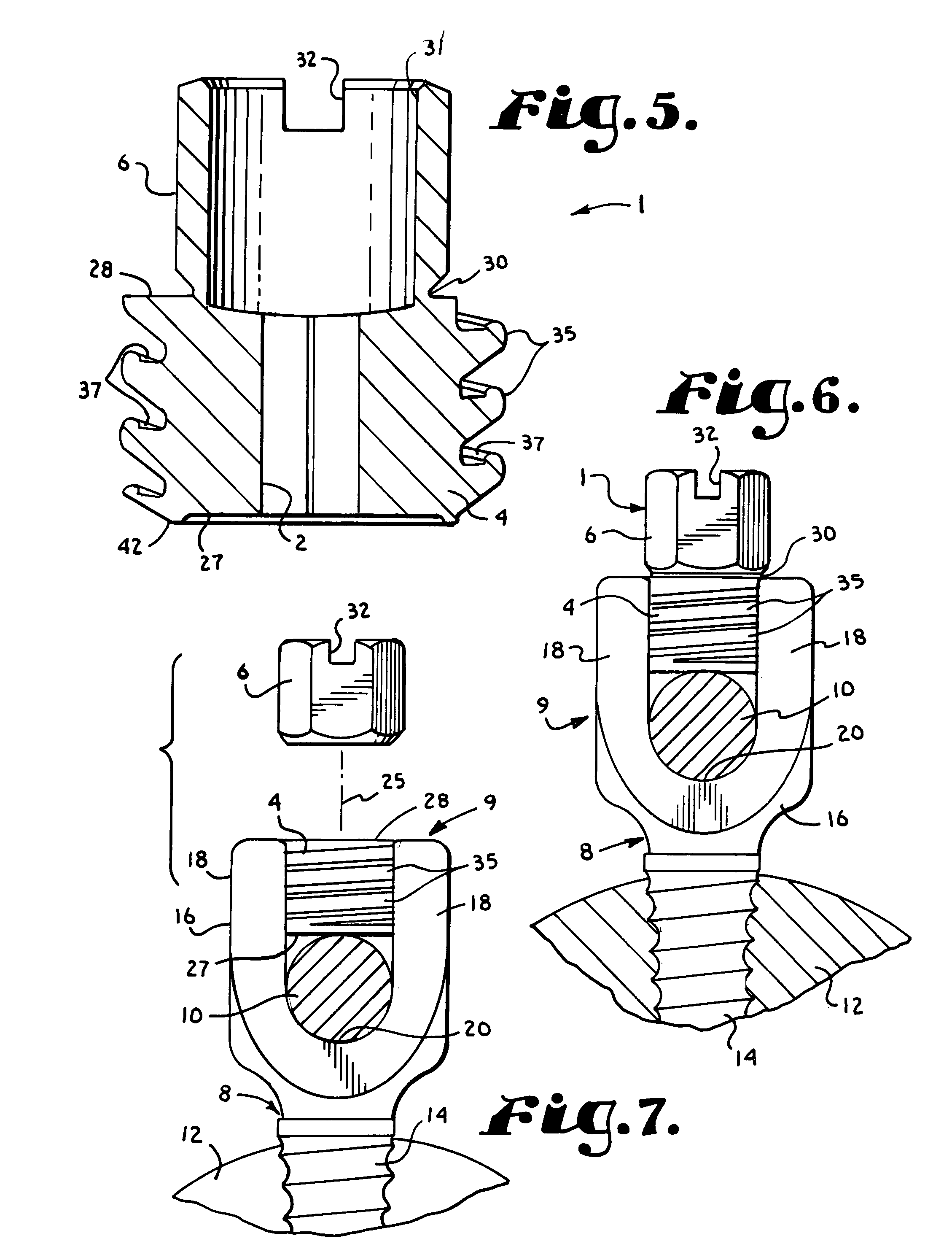 Anti-splay medical implant closure with multi-surface removal aperture