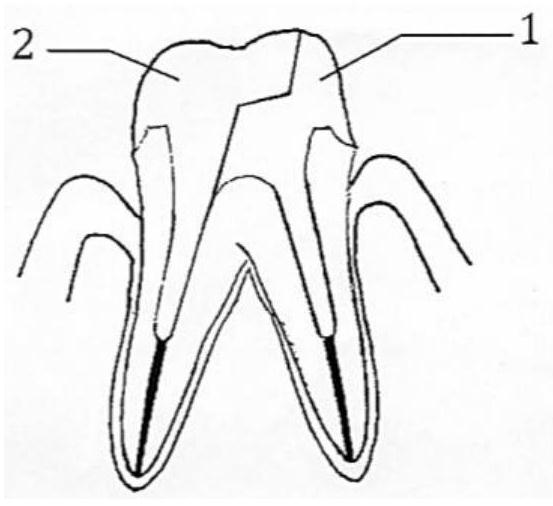 Chimeric type pile core body for tooth defect repair as well as preparation method and application thereof