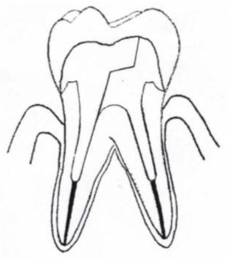 Chimeric type pile core body for tooth defect repair as well as preparation method and application thereof