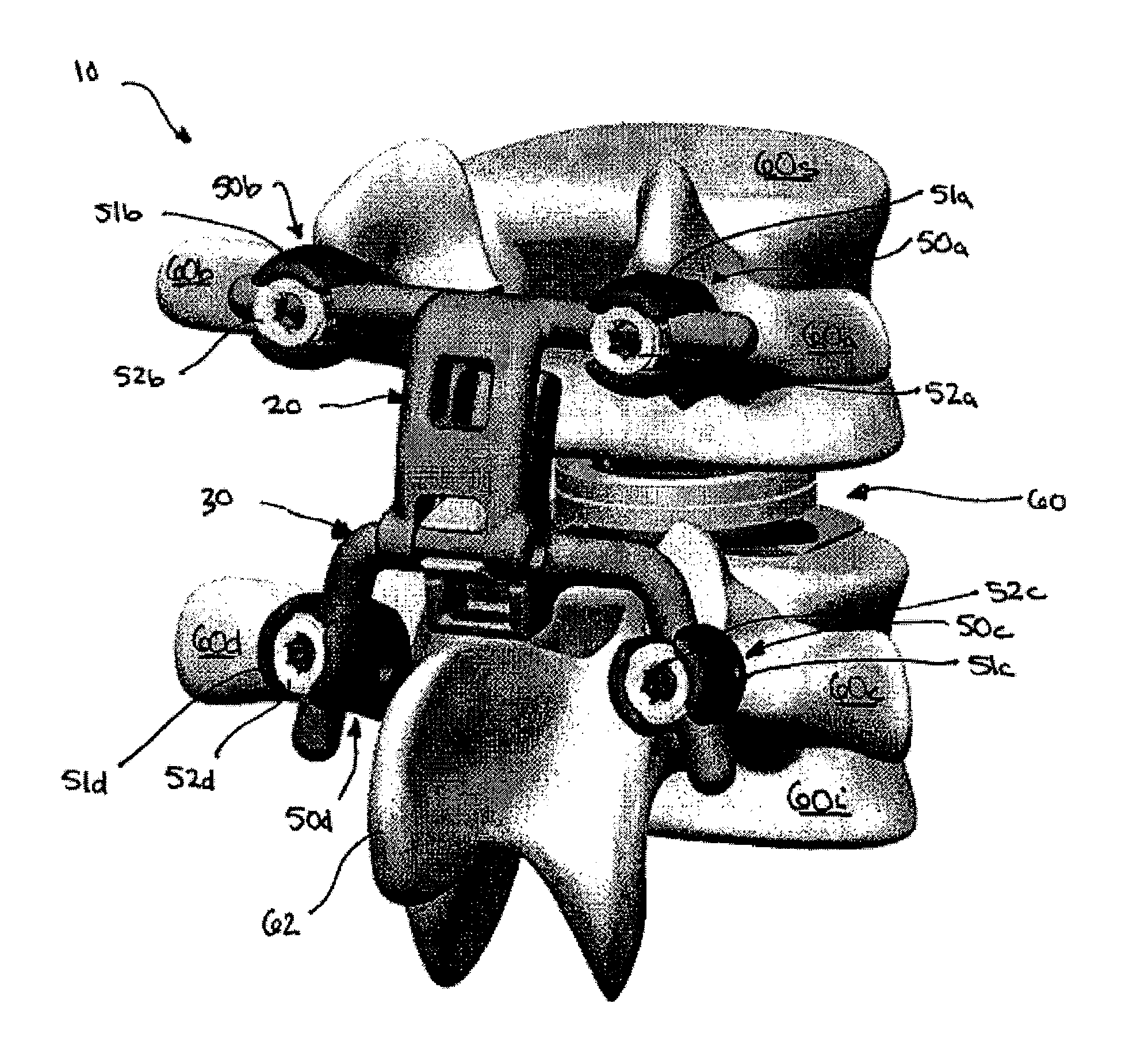 Posterior stabilization system