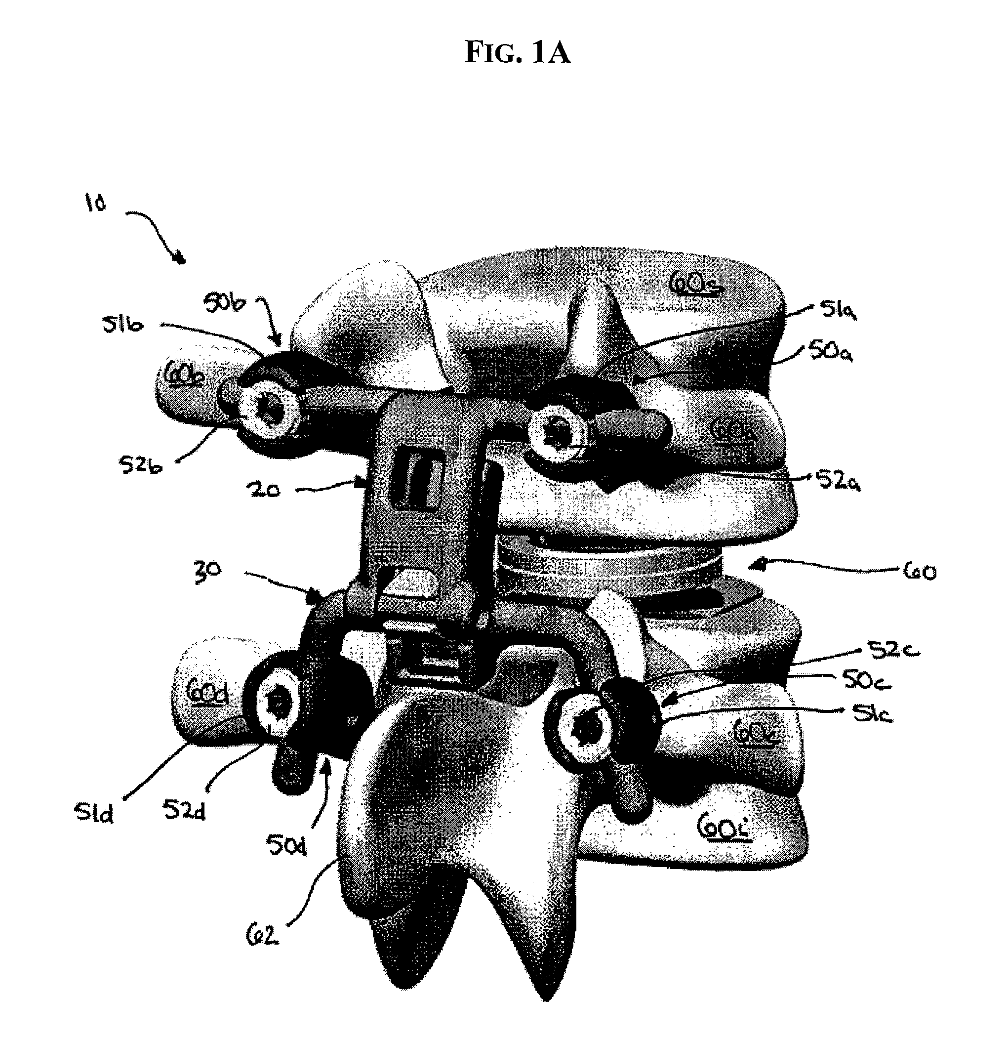 Posterior stabilization system