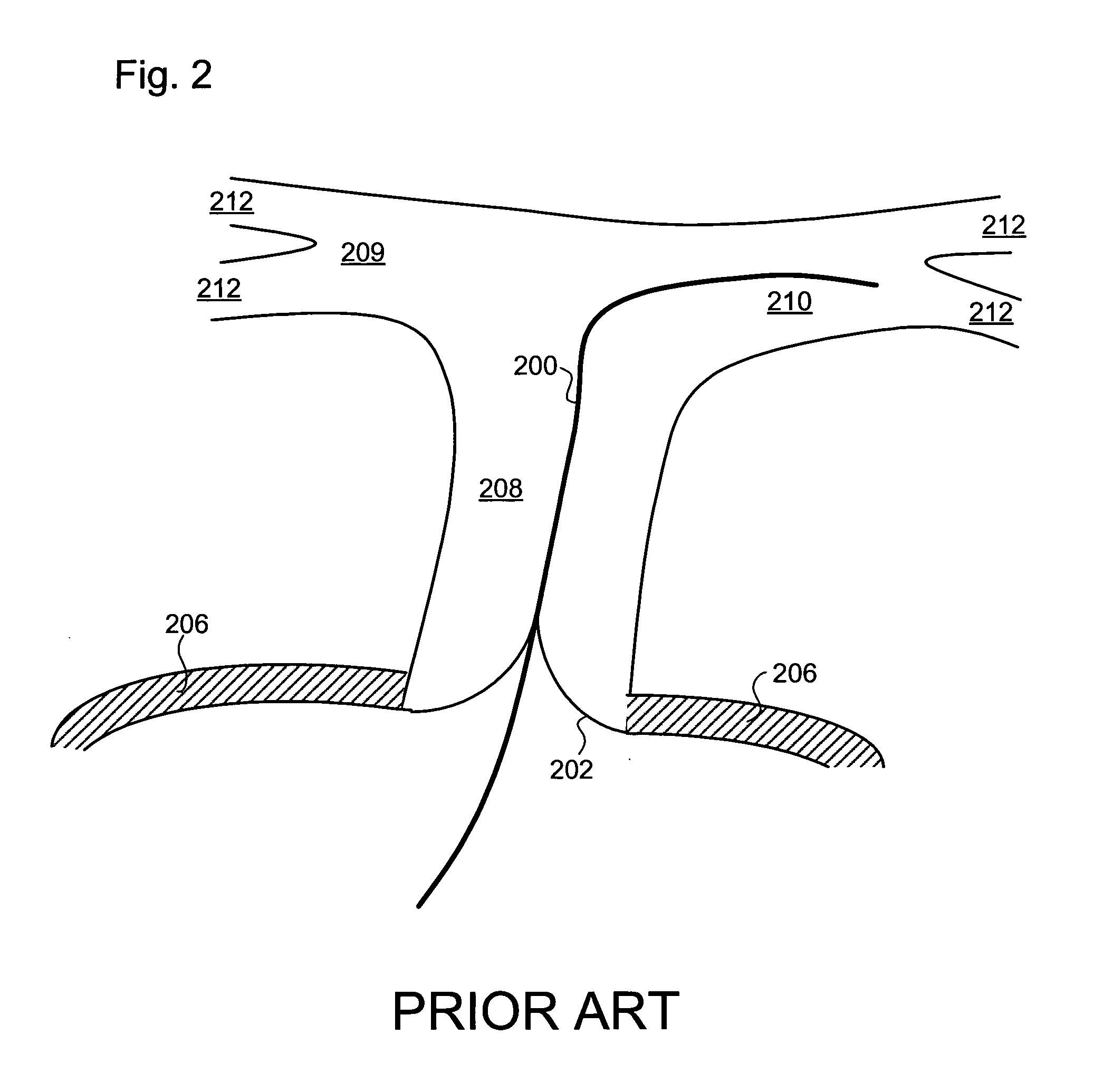 Guidewire with anchor