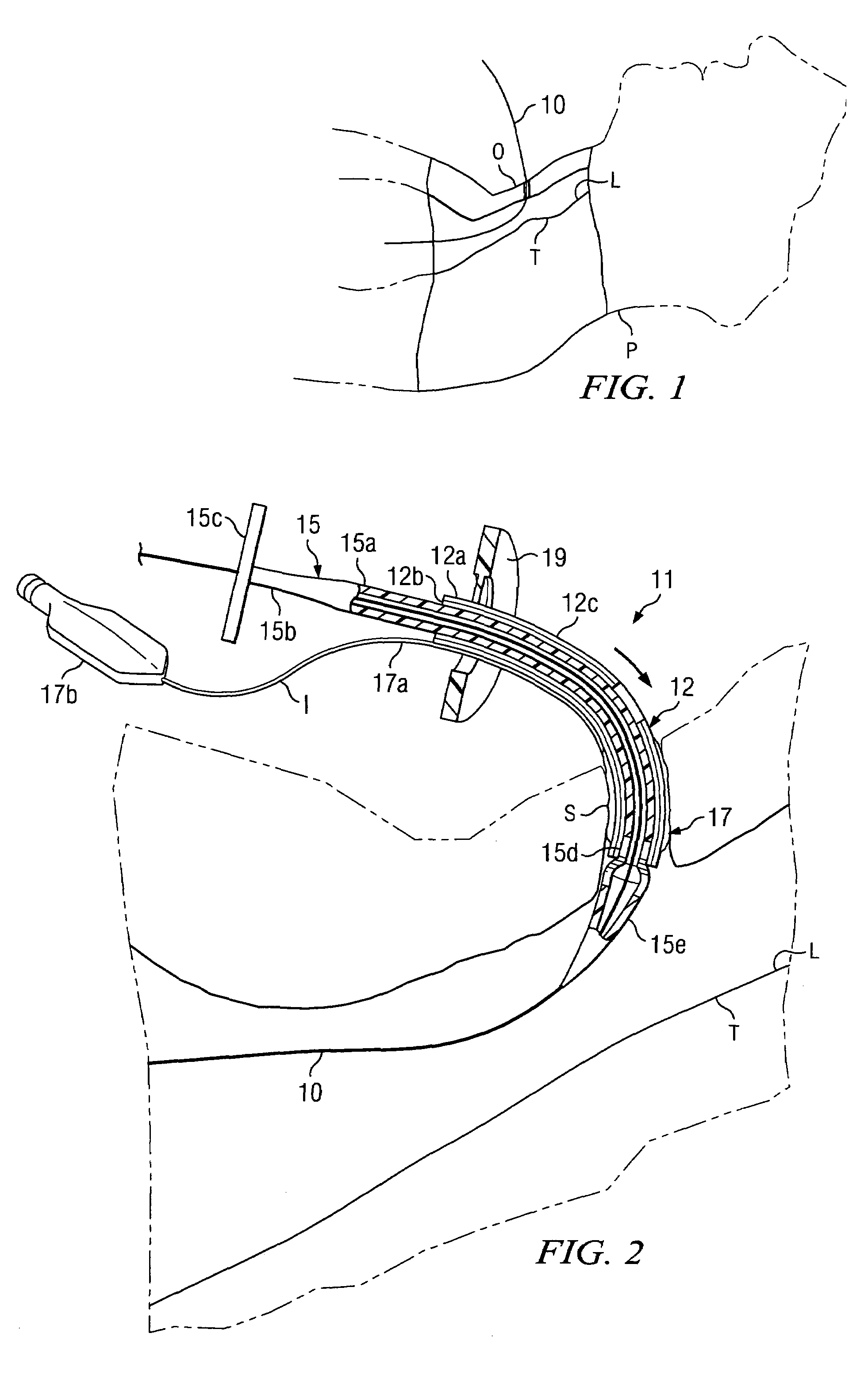 Tracheostomy system