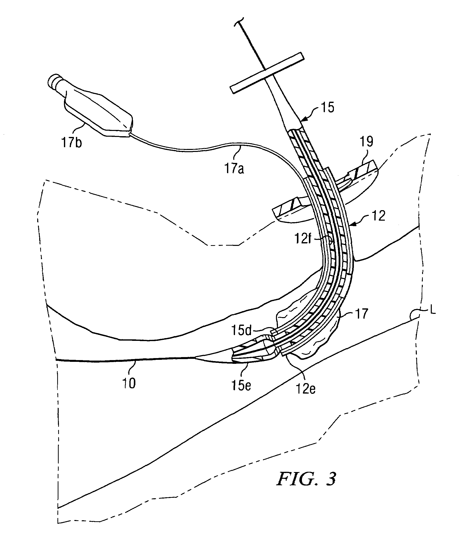 Tracheostomy system