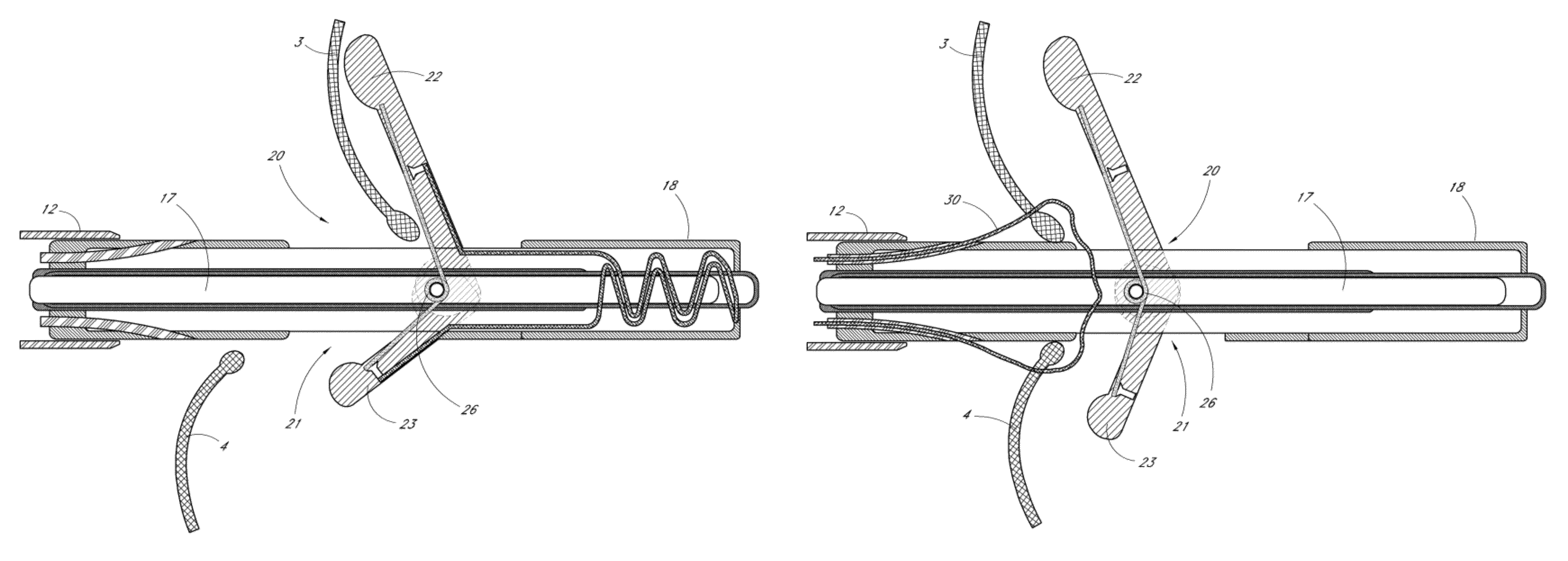 Methods and apparatus for atrioventricular valve repair