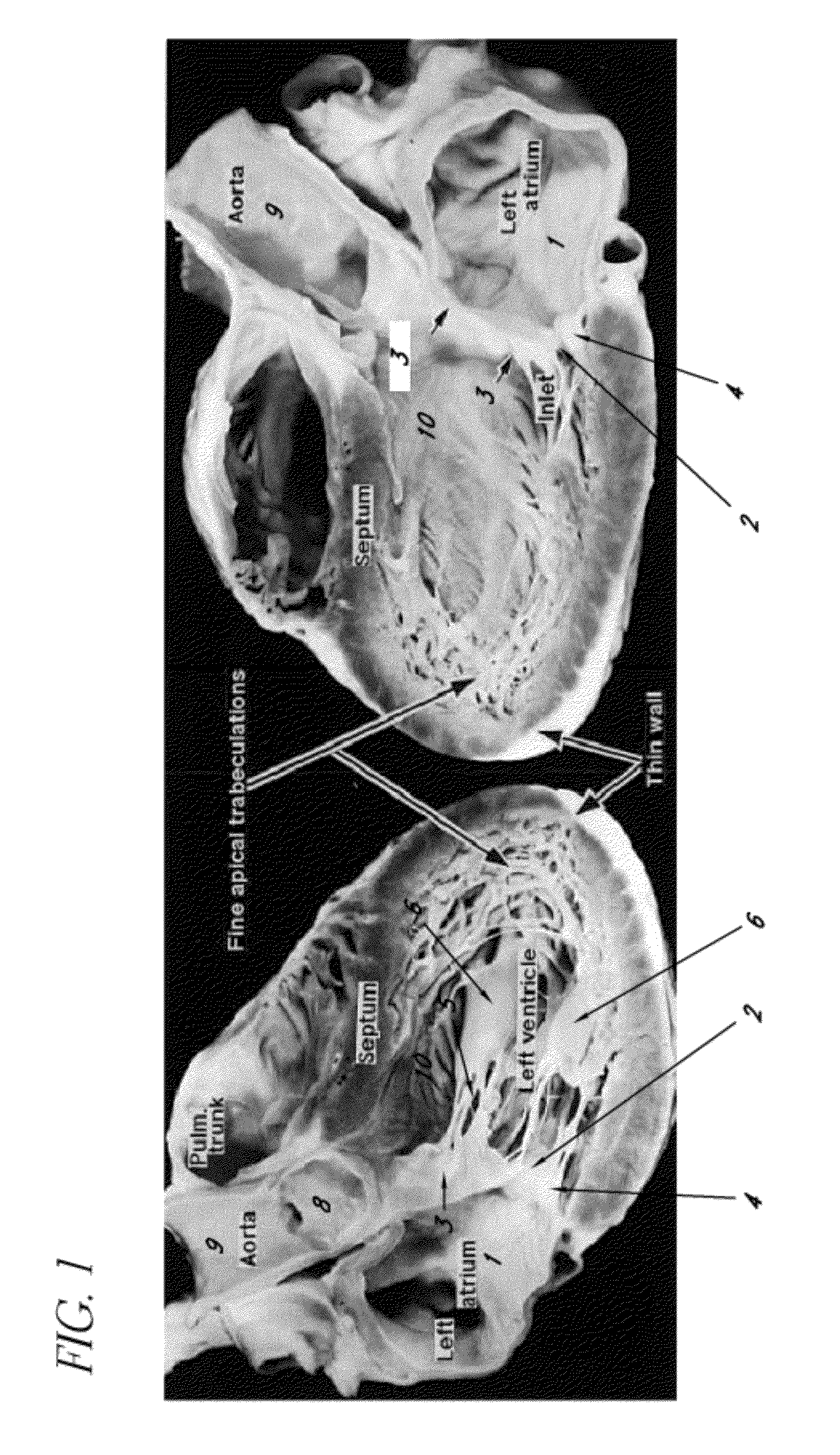 Methods and apparatus for atrioventricular valve repair