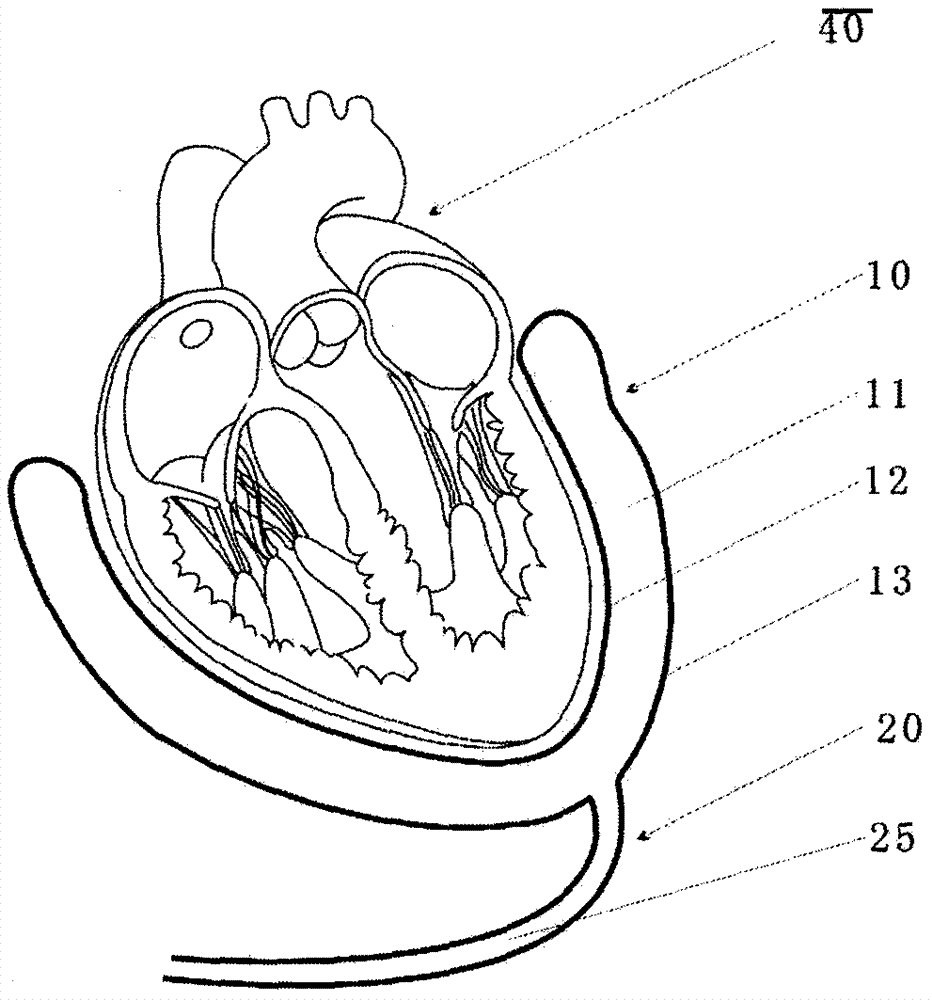 Pneumatic type balloon heart assisting apparatus