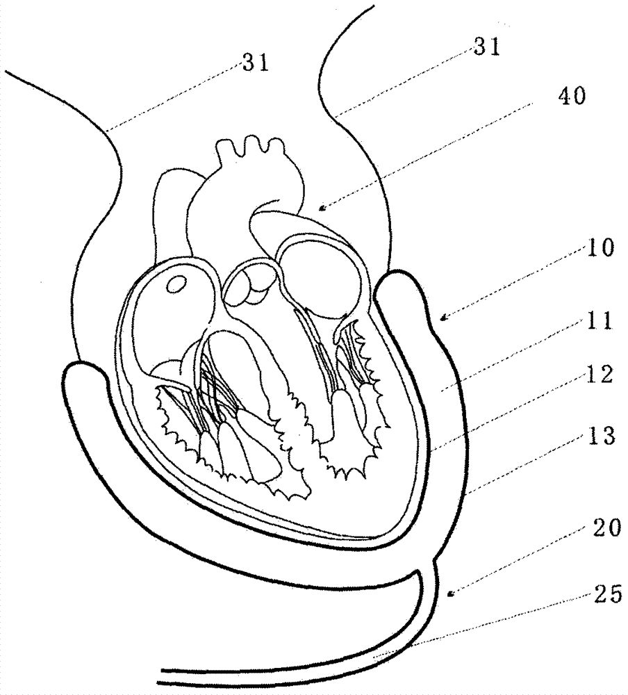 Pneumatic type balloon heart assisting apparatus