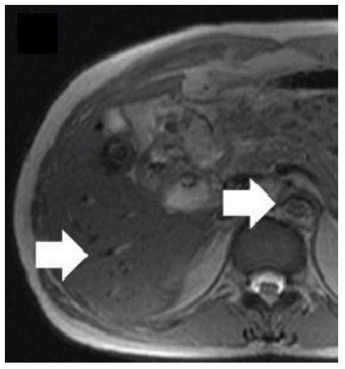 Method and system for controlling black blood in time-reversal steady state free precession quick imaging sequence