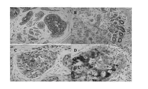 AKR1B10 (aldo-keto reductase family 1 B10) gene protein as breast cancer diagnostic marker and drug target