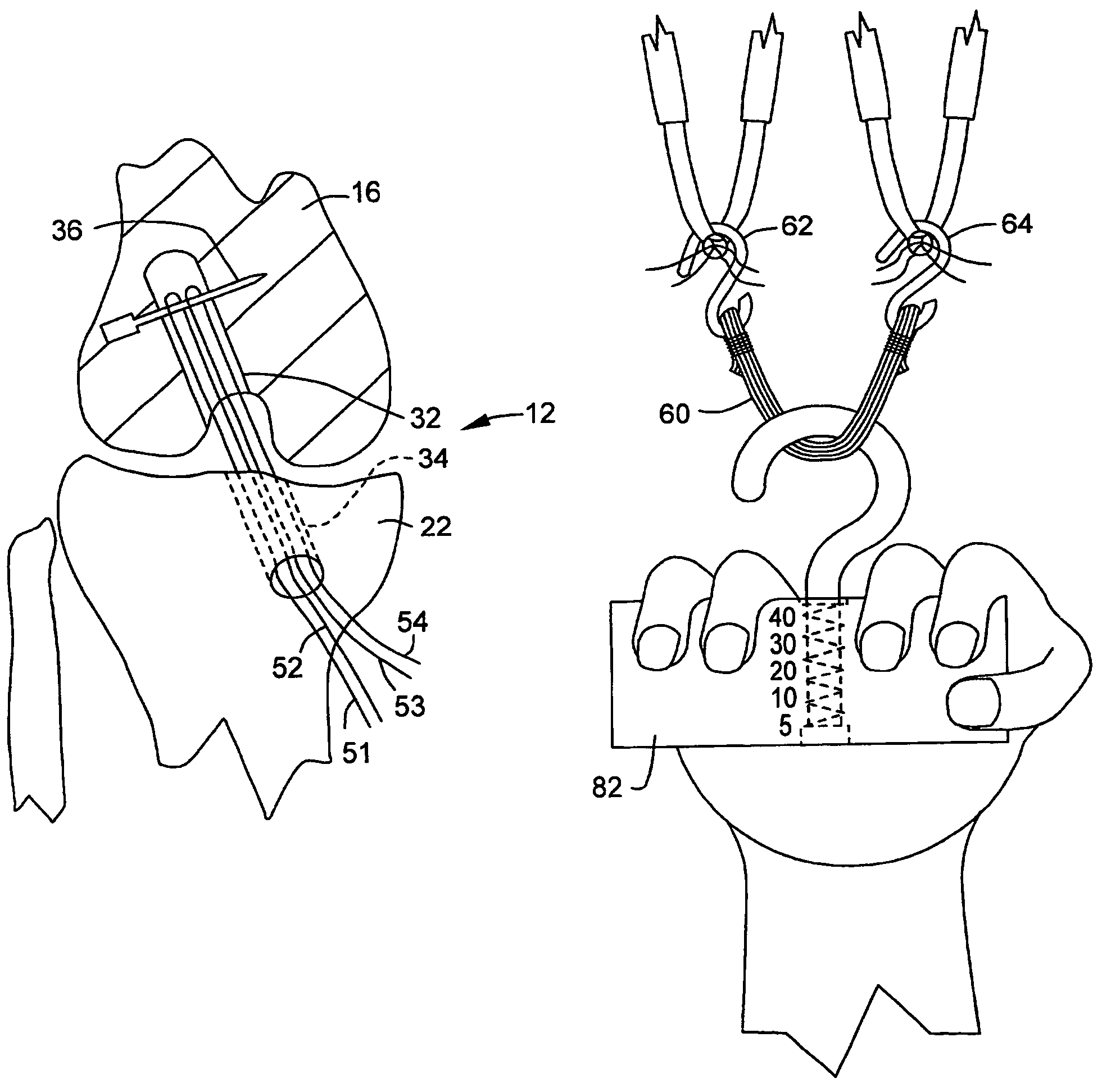 Method for reconstructing a knee