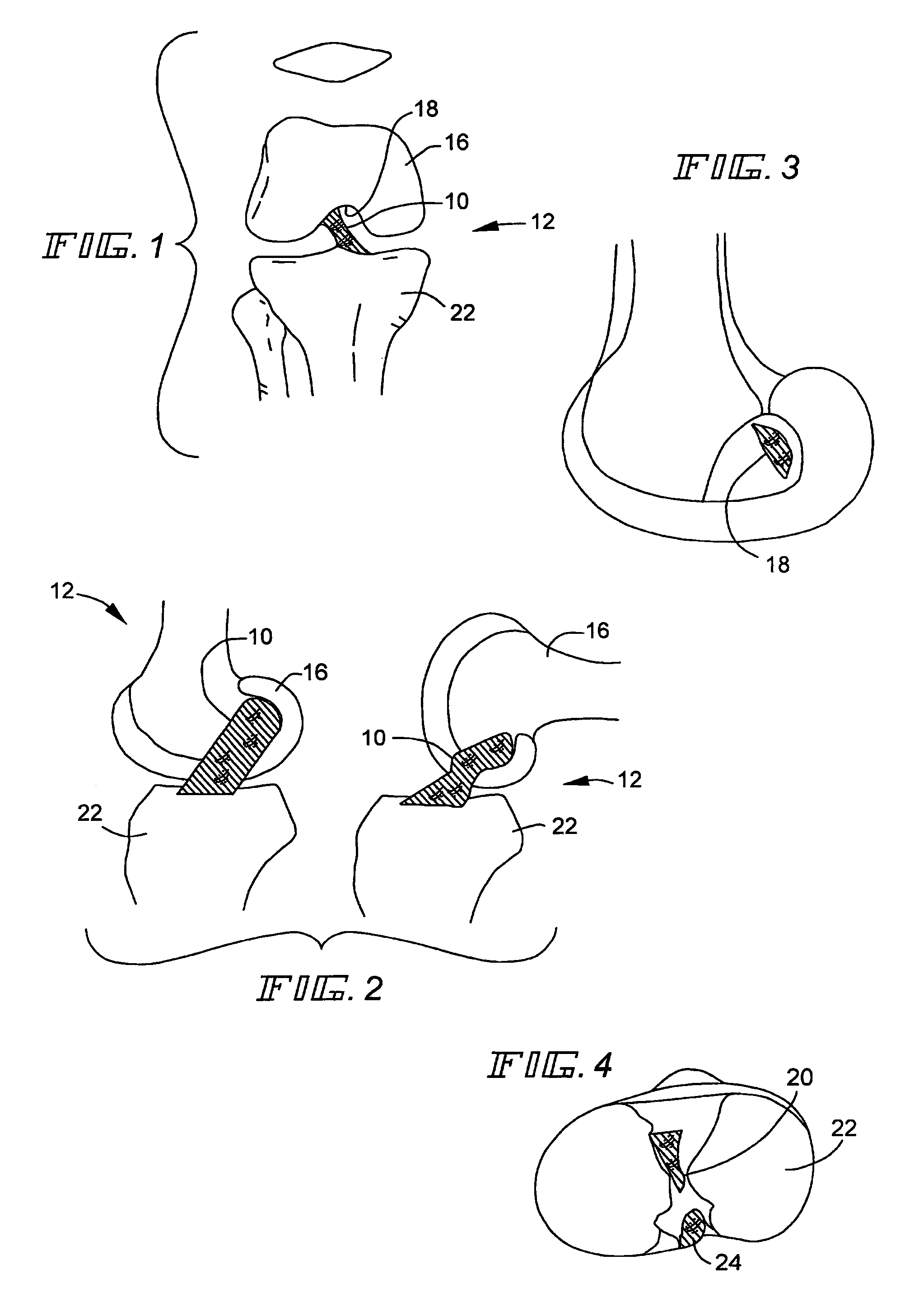 Method for reconstructing a knee