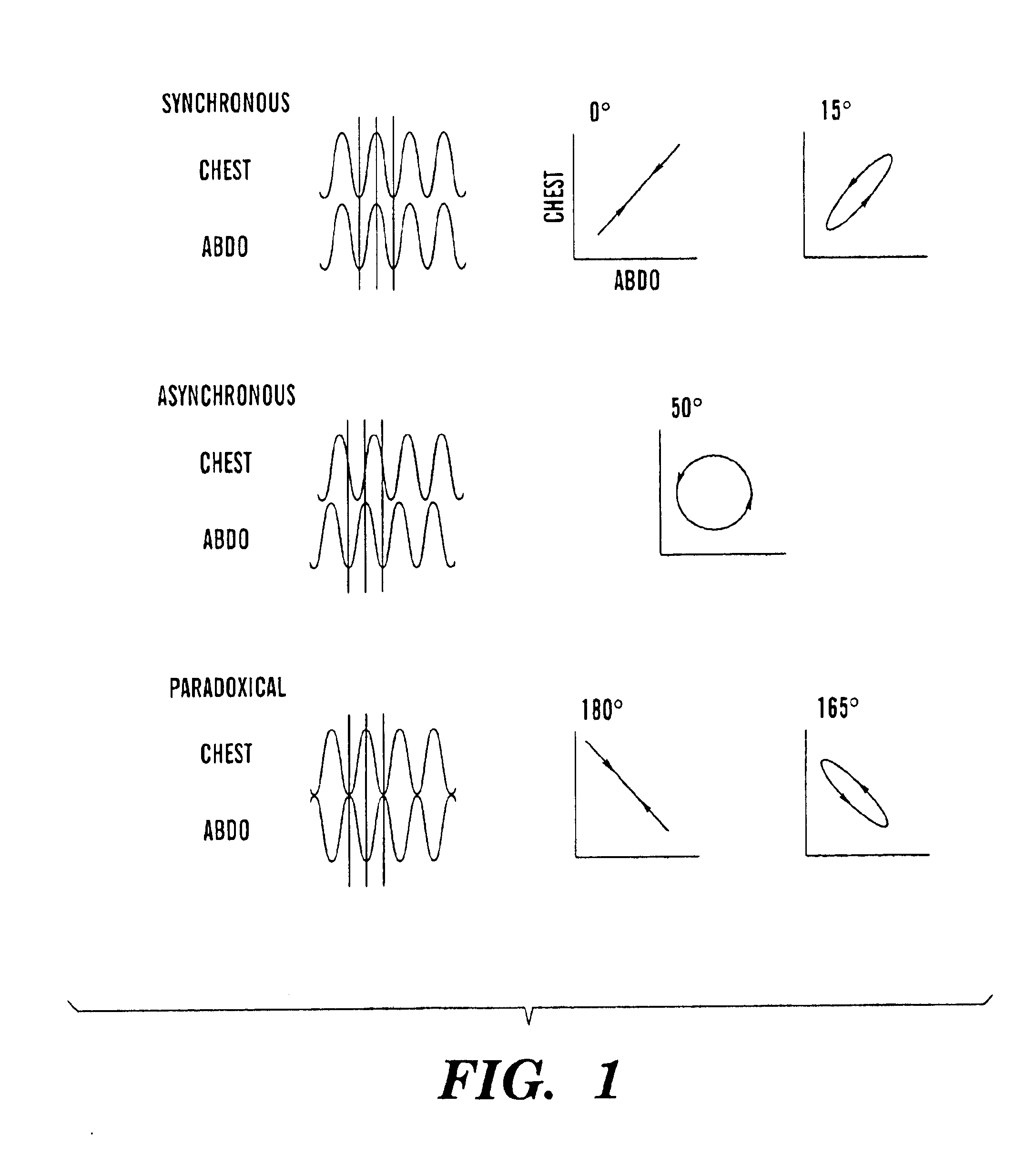 Analysis of Sleep Apnea