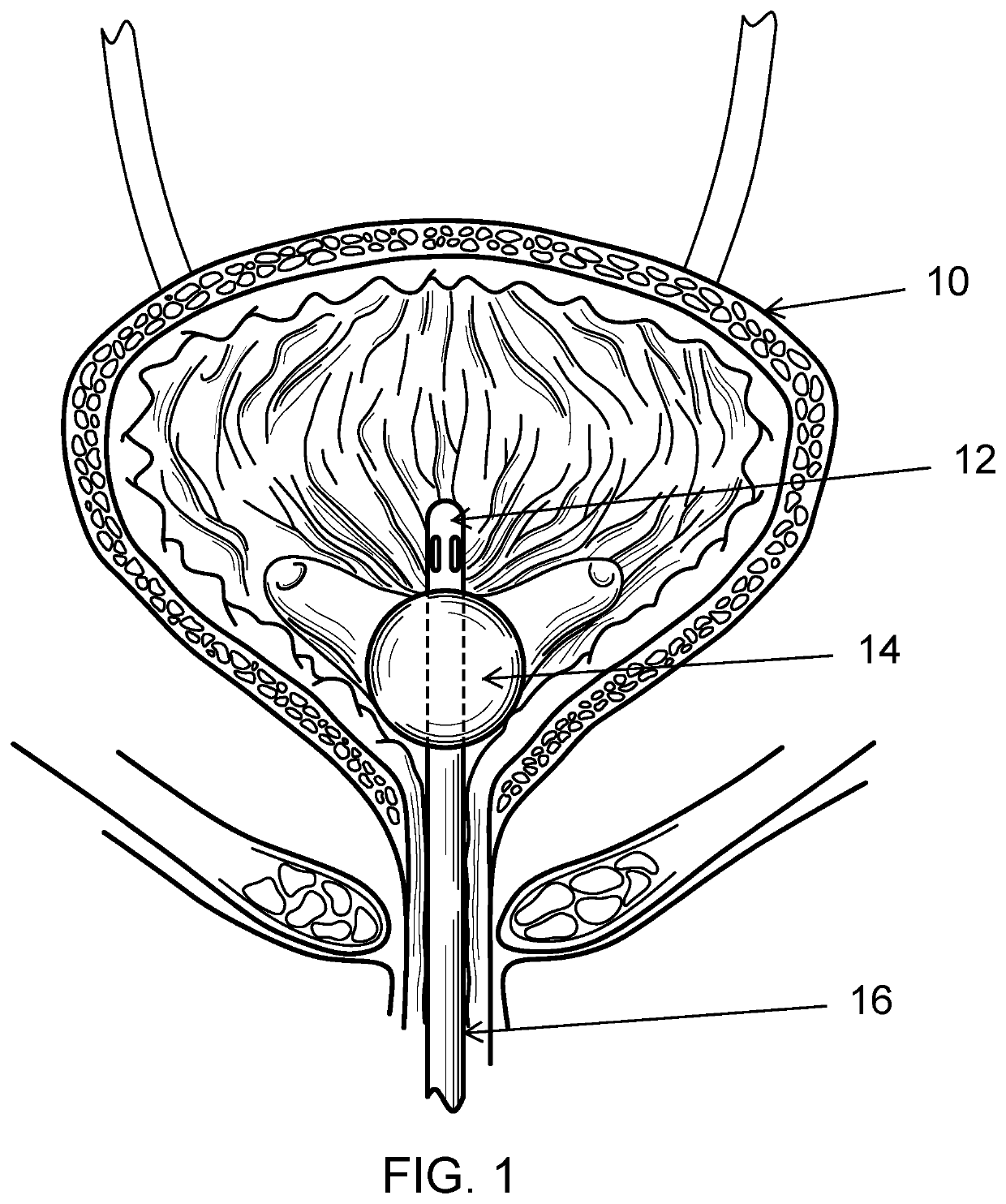 Catheter system for continuous irrigation