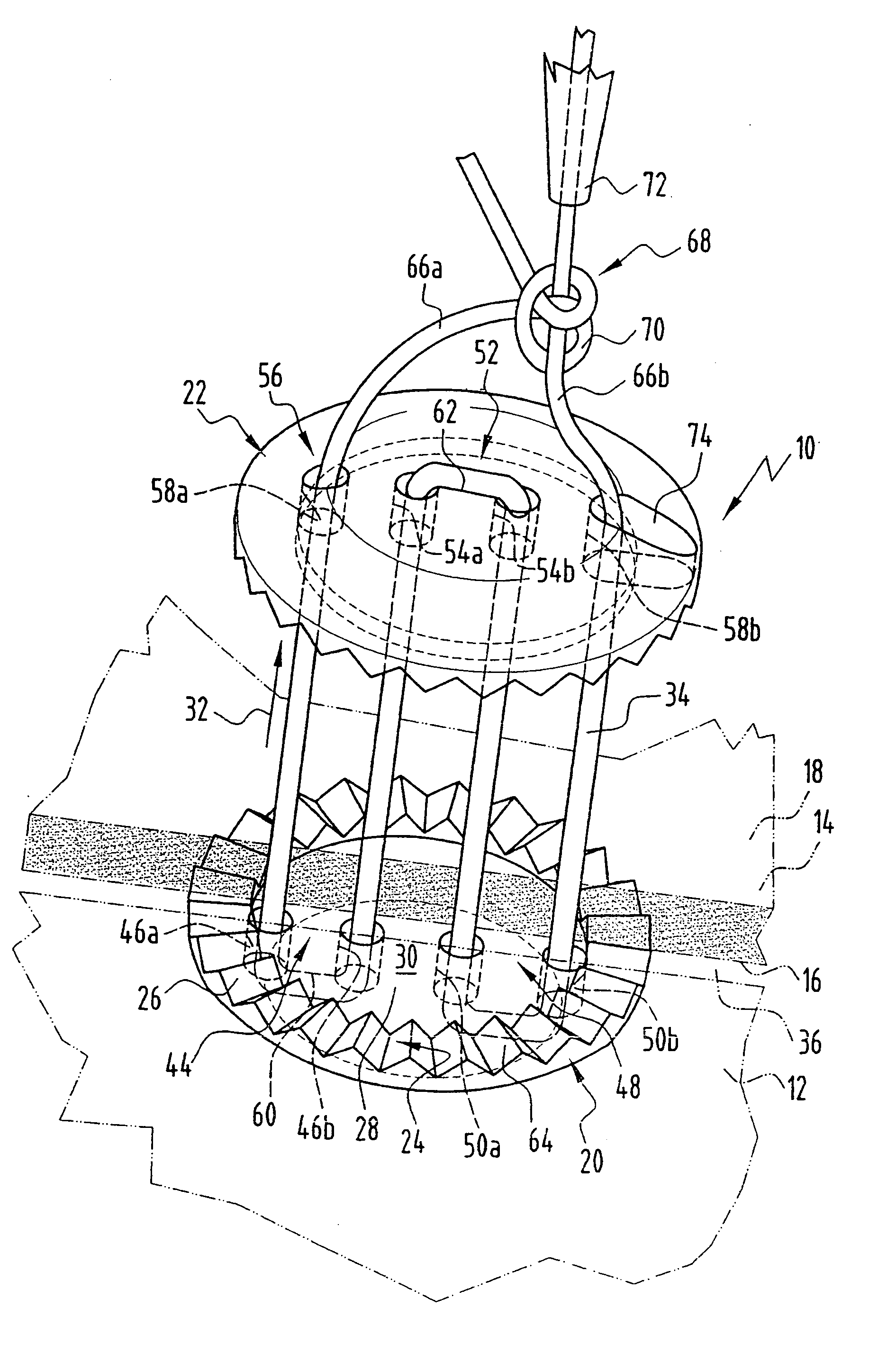 Implant for securing neighbouring bone plates