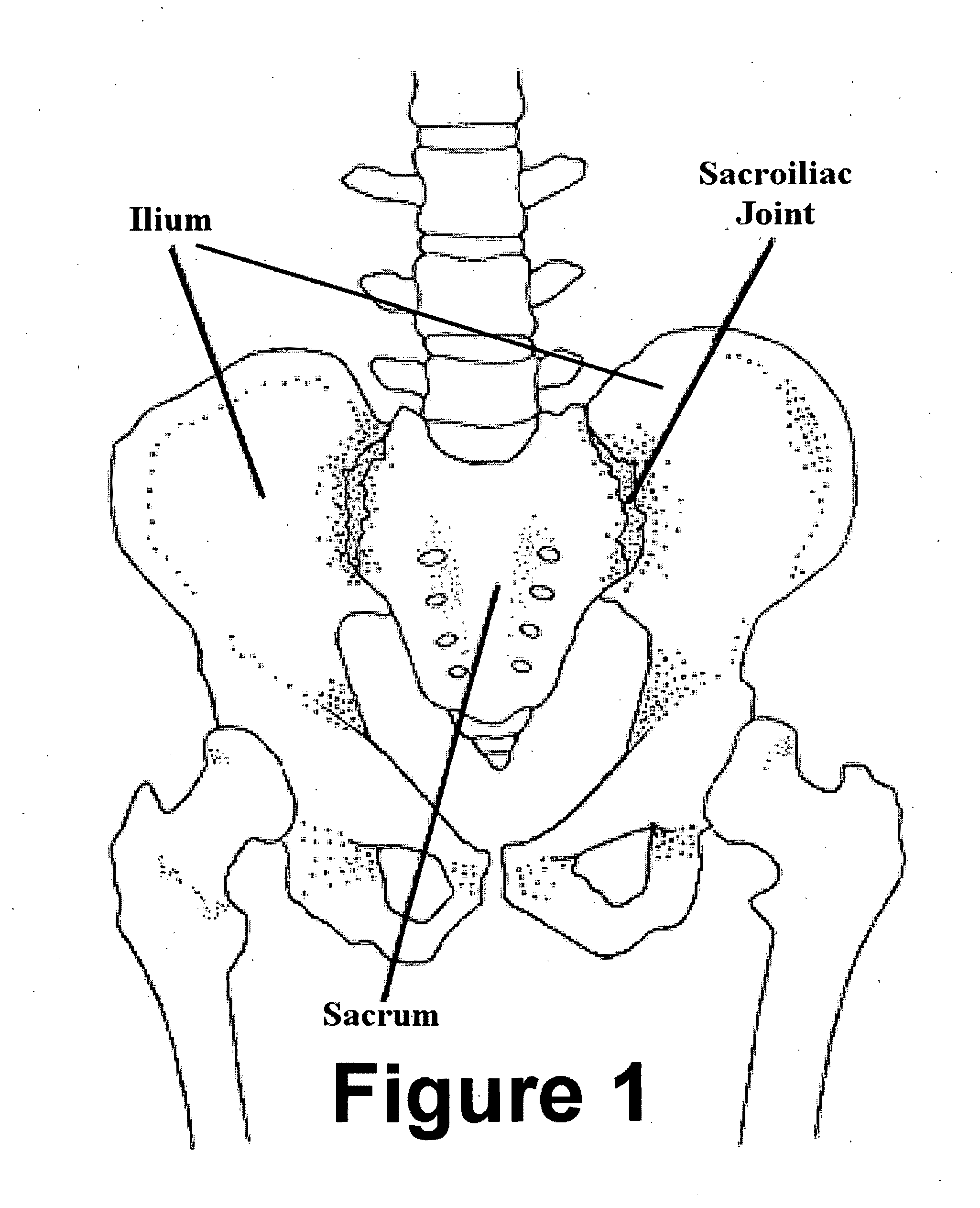 Method and apparatus for minimally invasive treatment of unstable pelvic ring injuries