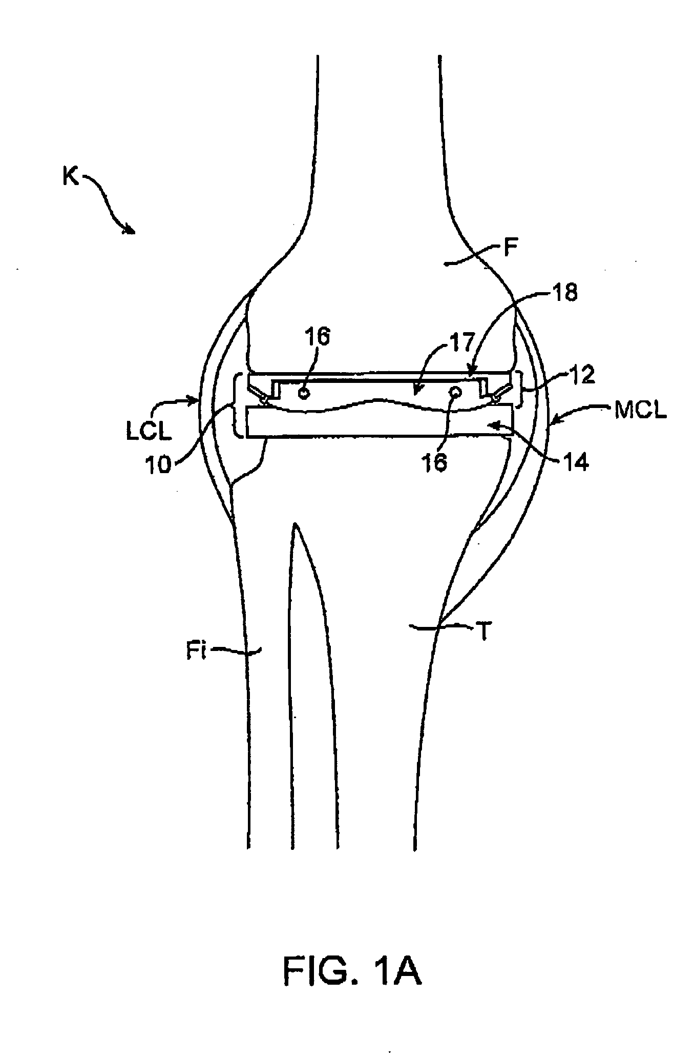 Dynamic knee balancer with pressure sensing