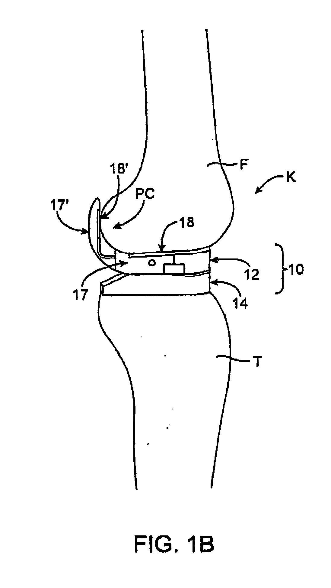 Dynamic knee balancer with pressure sensing