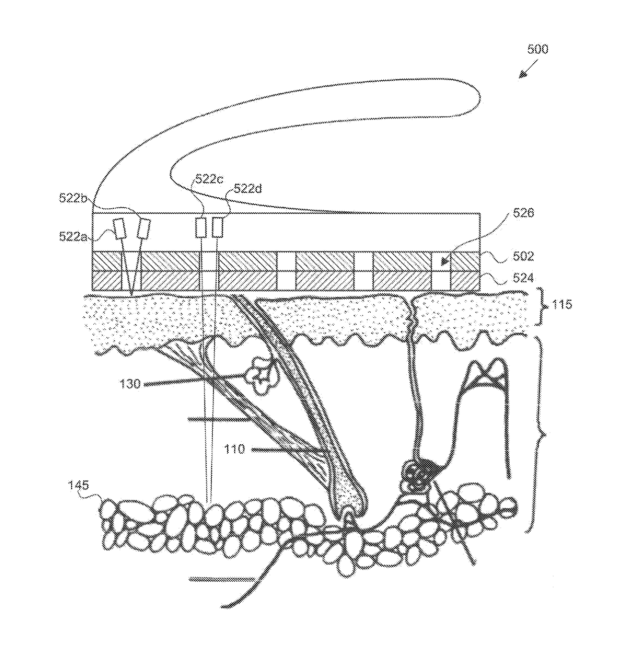 Methods, kits, and cooling devices for disrupting function of one or more sebaceous glands