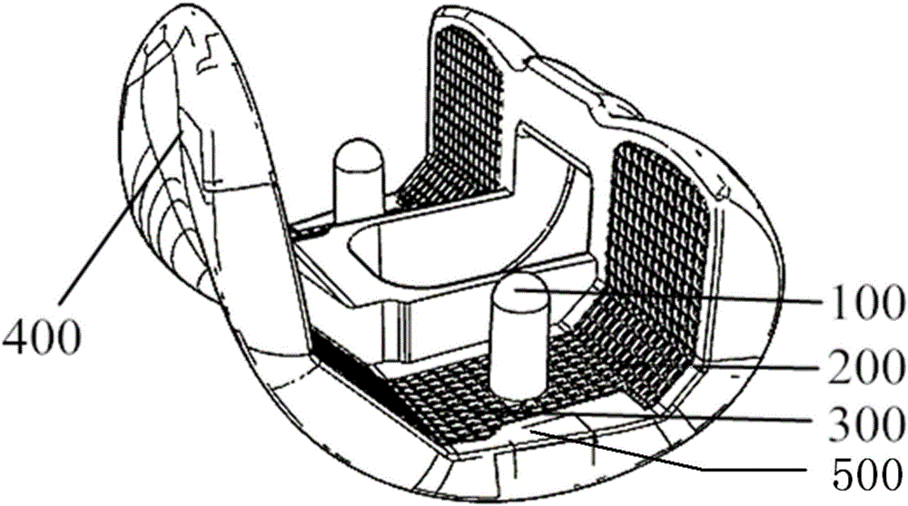 Personalized femoral prosthesis and manufacturing method