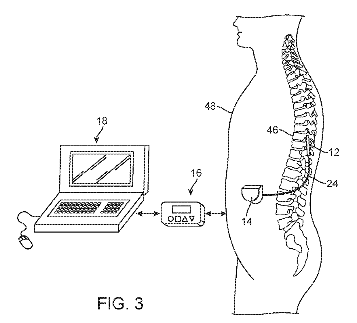 Systems and methods of providing modulation therapy without patient-perception of stimulation