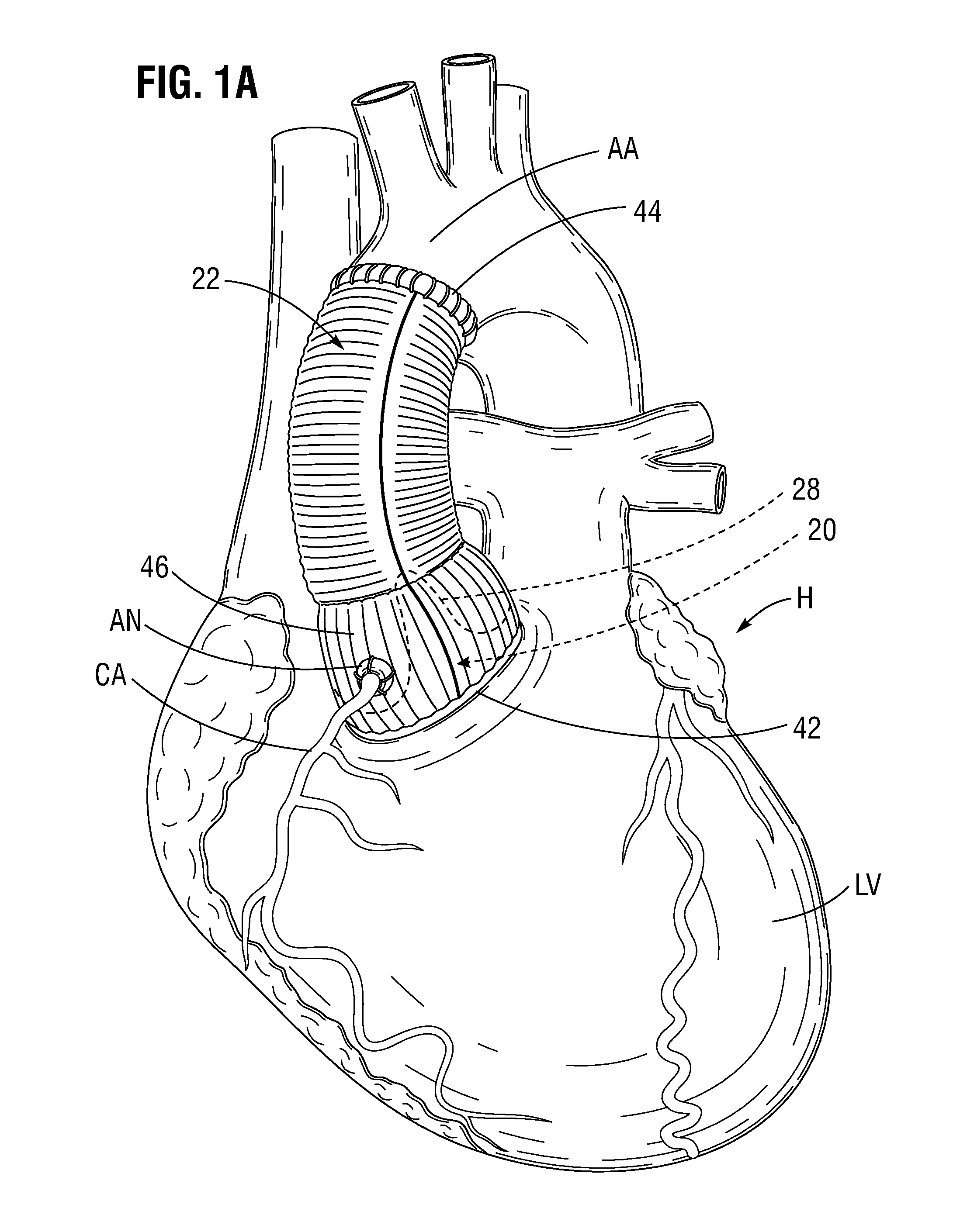 Pre-assembled bioprosthetic valve and sealed conduit