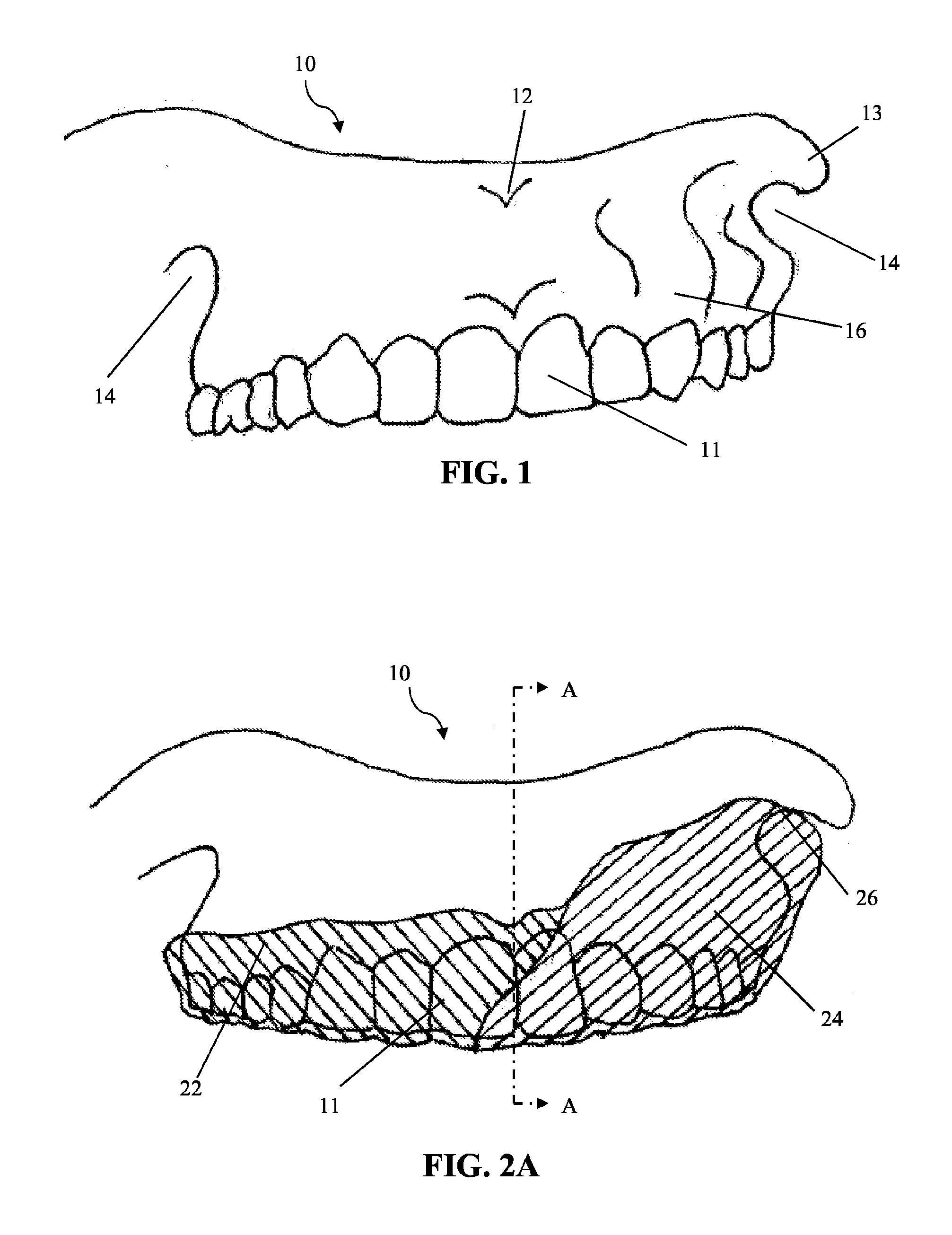 Intra-oral appliance and methods of using same