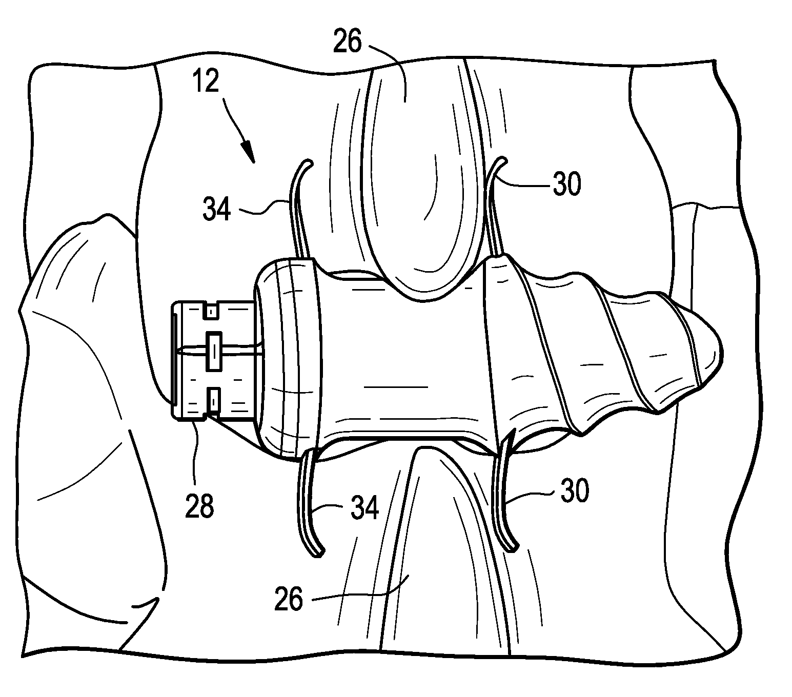 Conical interspinous apparatus and a method of performing interspinous distraction