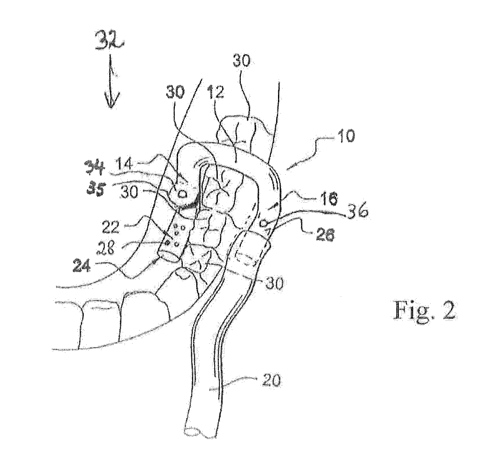 Cannulae for evacuating saliva and/or blood flow