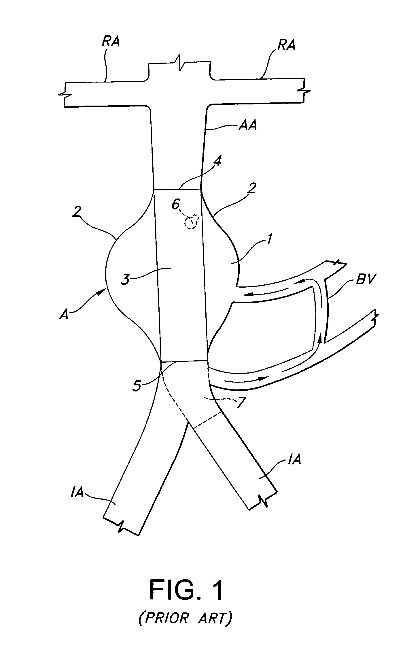 Implantable prosthesis with displaceable skirt