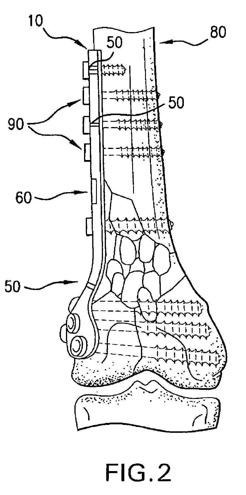 Orthopaedic implant with sensors