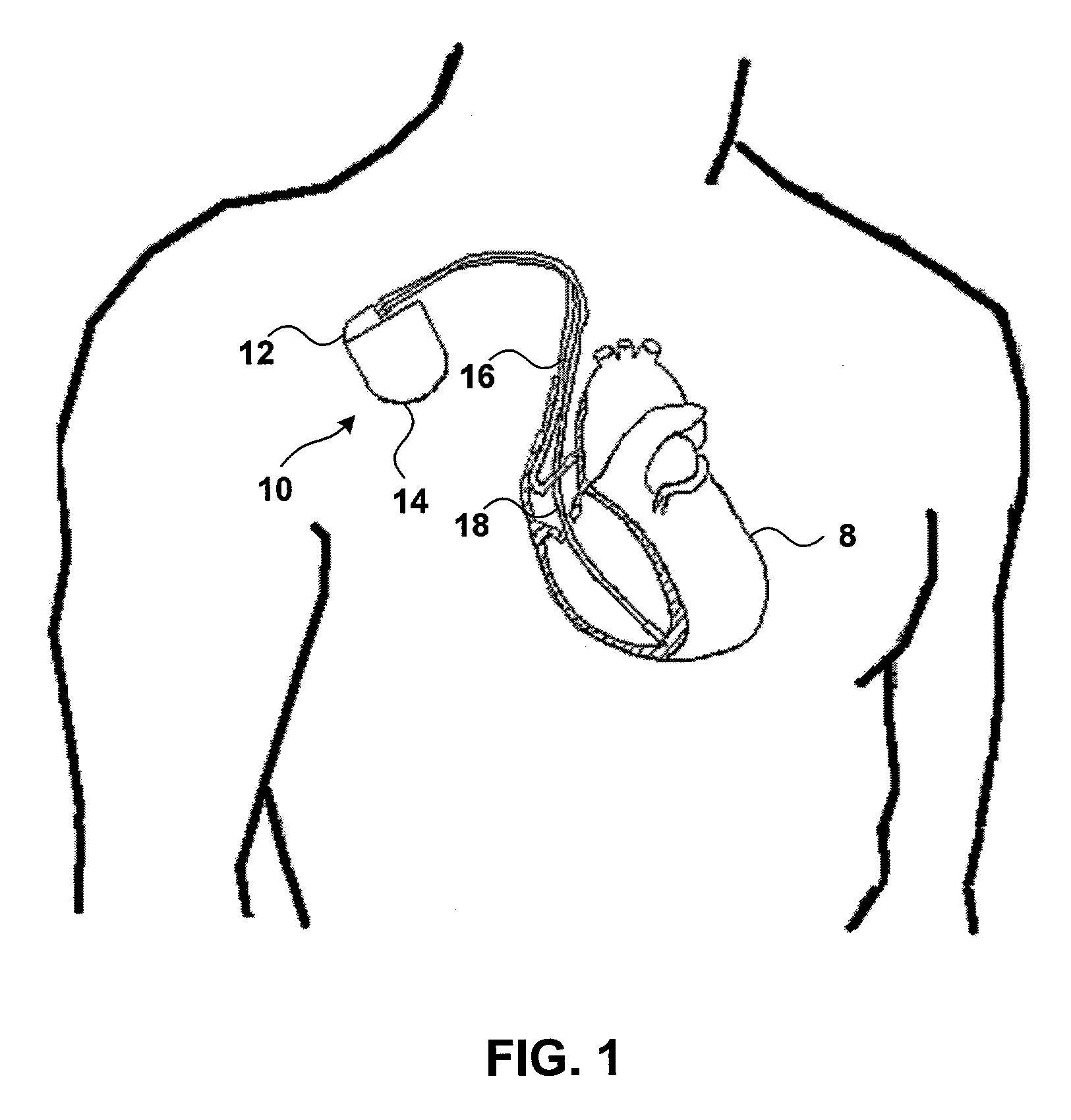 Insulin-mediated glucose uptake monitor