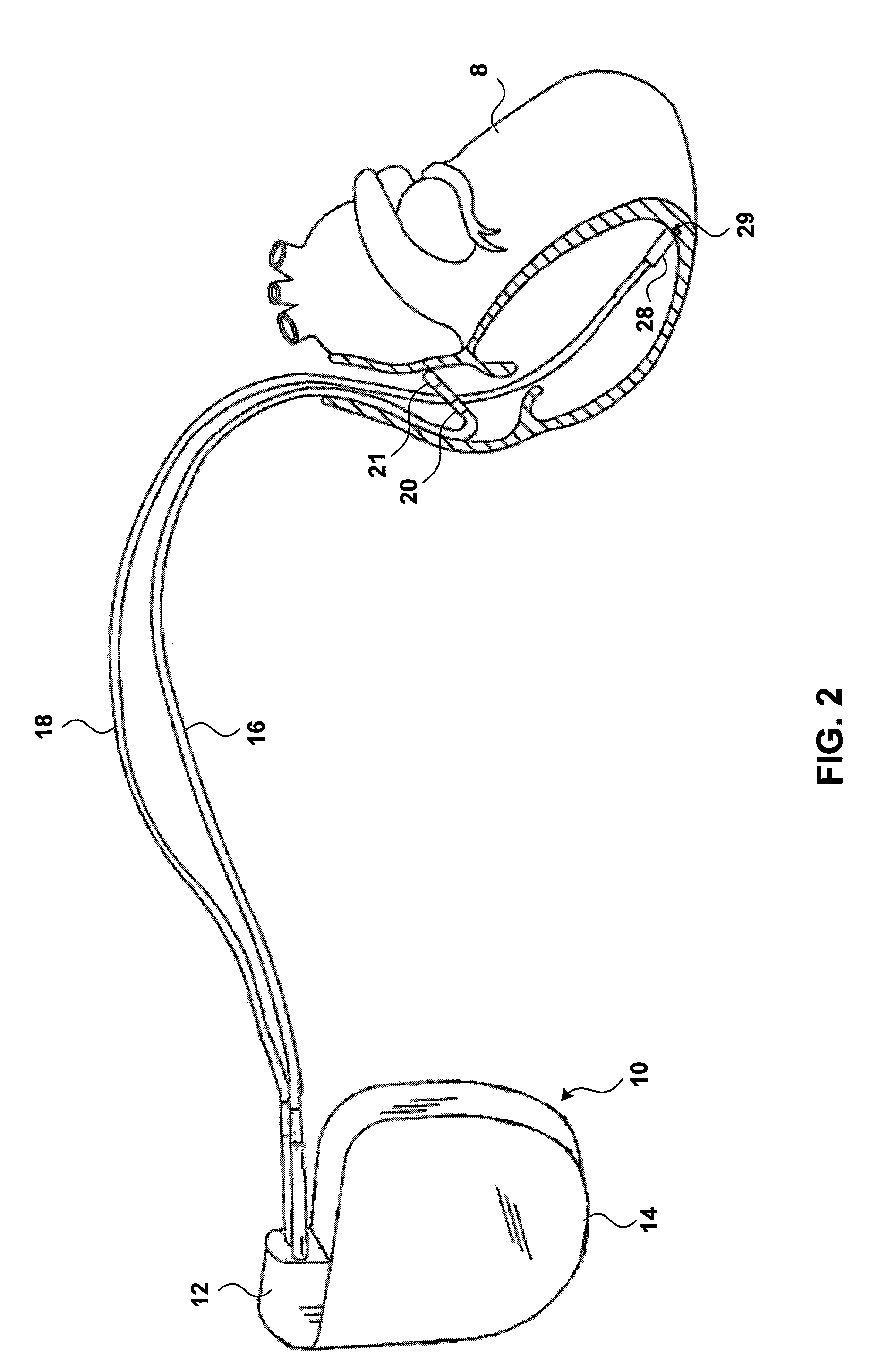 Insulin-mediated glucose uptake monitor