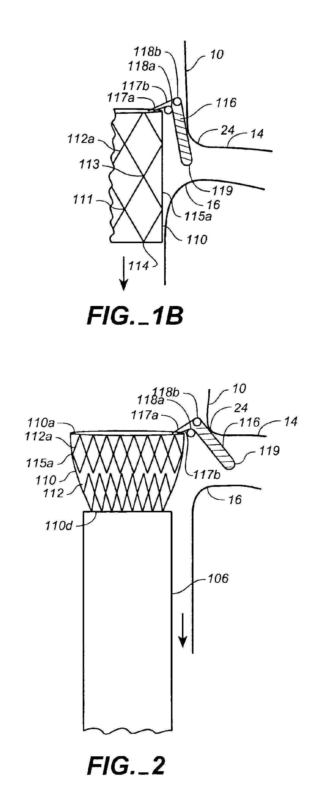 System for transrenal/intraostial fixation of endovascular prosthesis