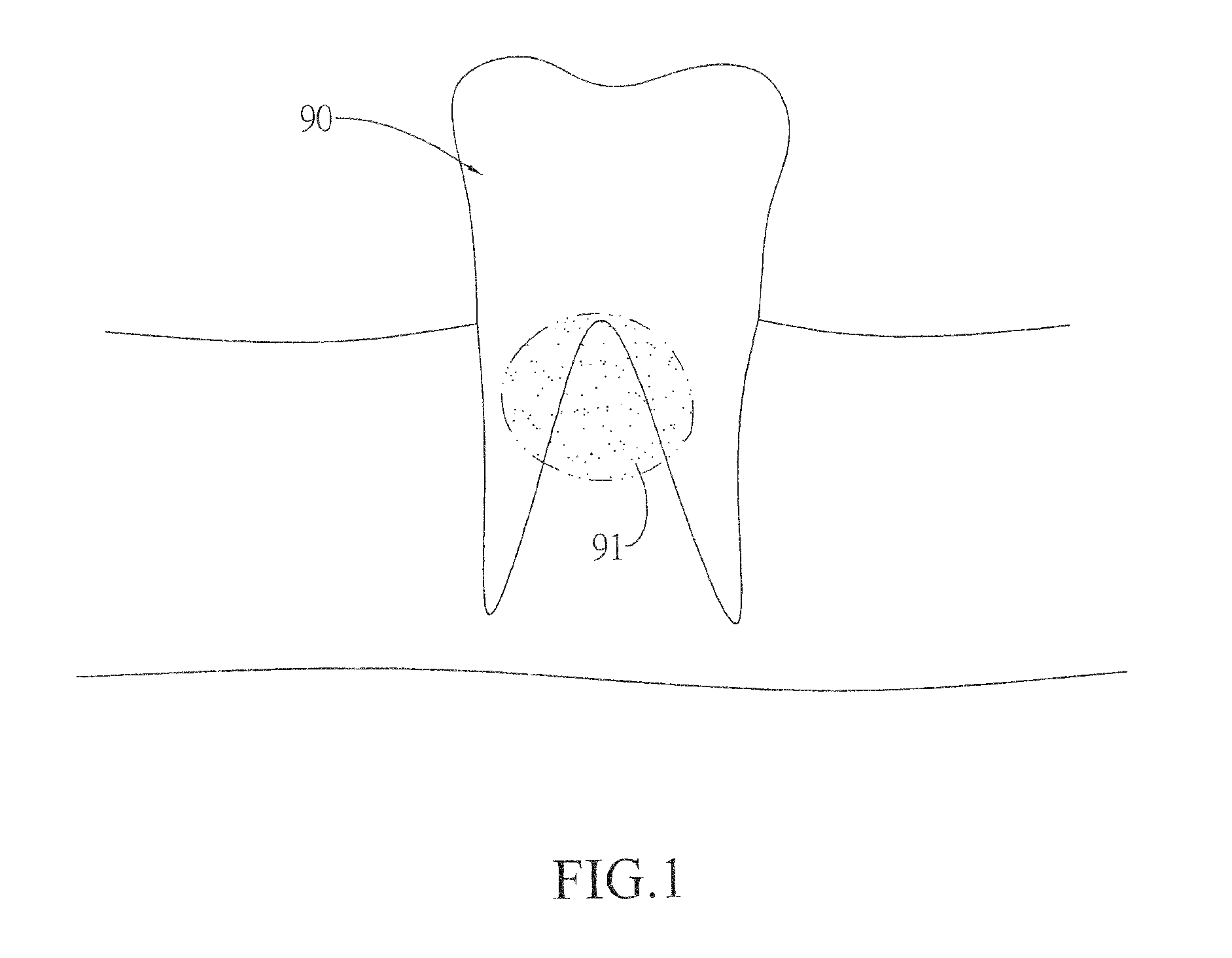 Artificial tooth with multiple internal crowns