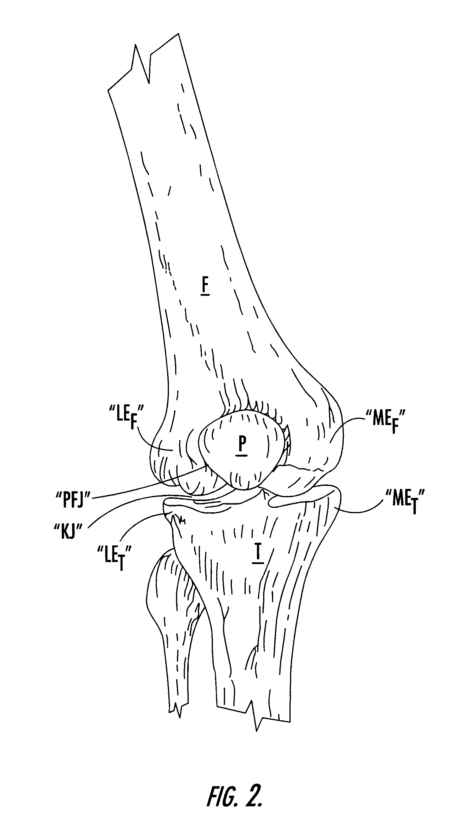 Custom-moldable support for patellar tendinitis