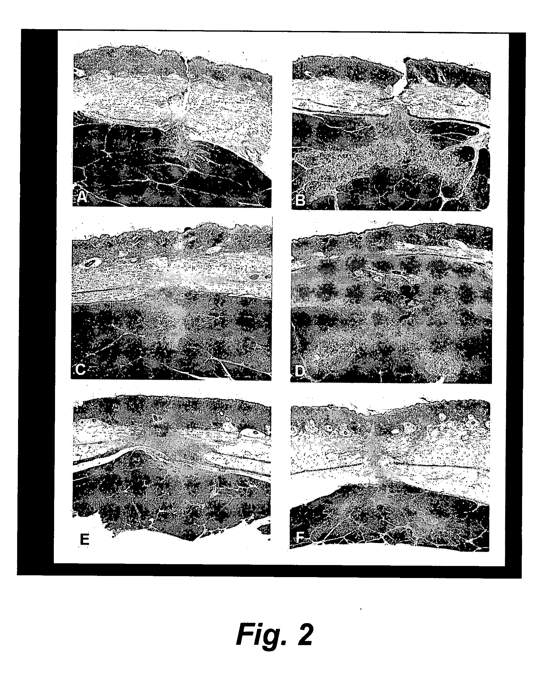 Method and device for treating microscopic tumors remaining in tissues following surgical resection