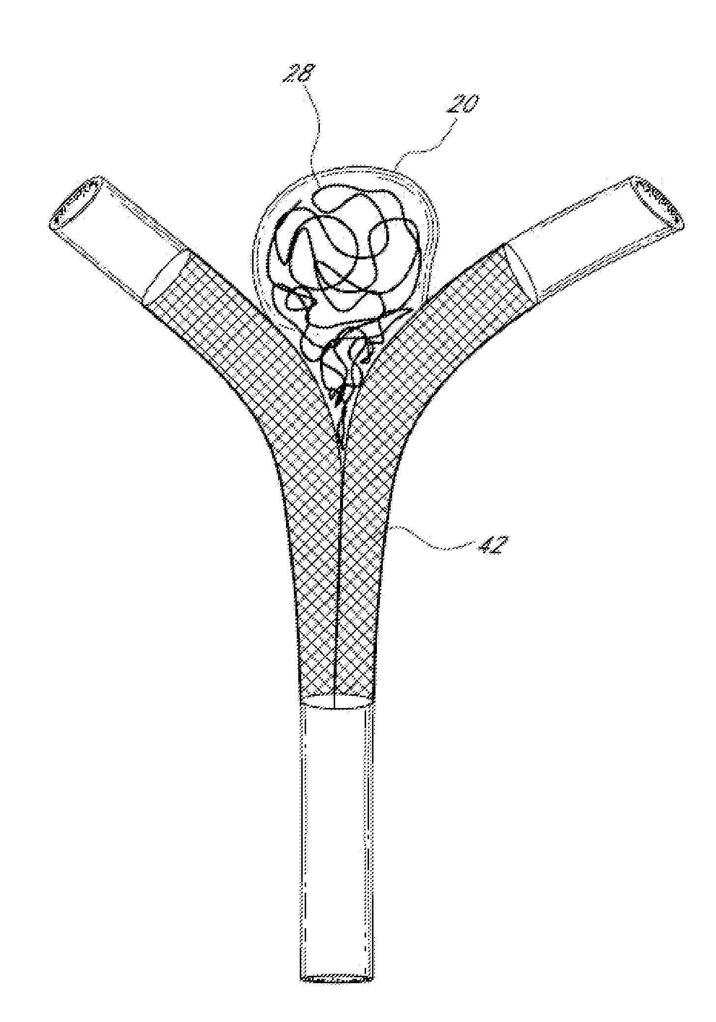 Vascular remodeling device