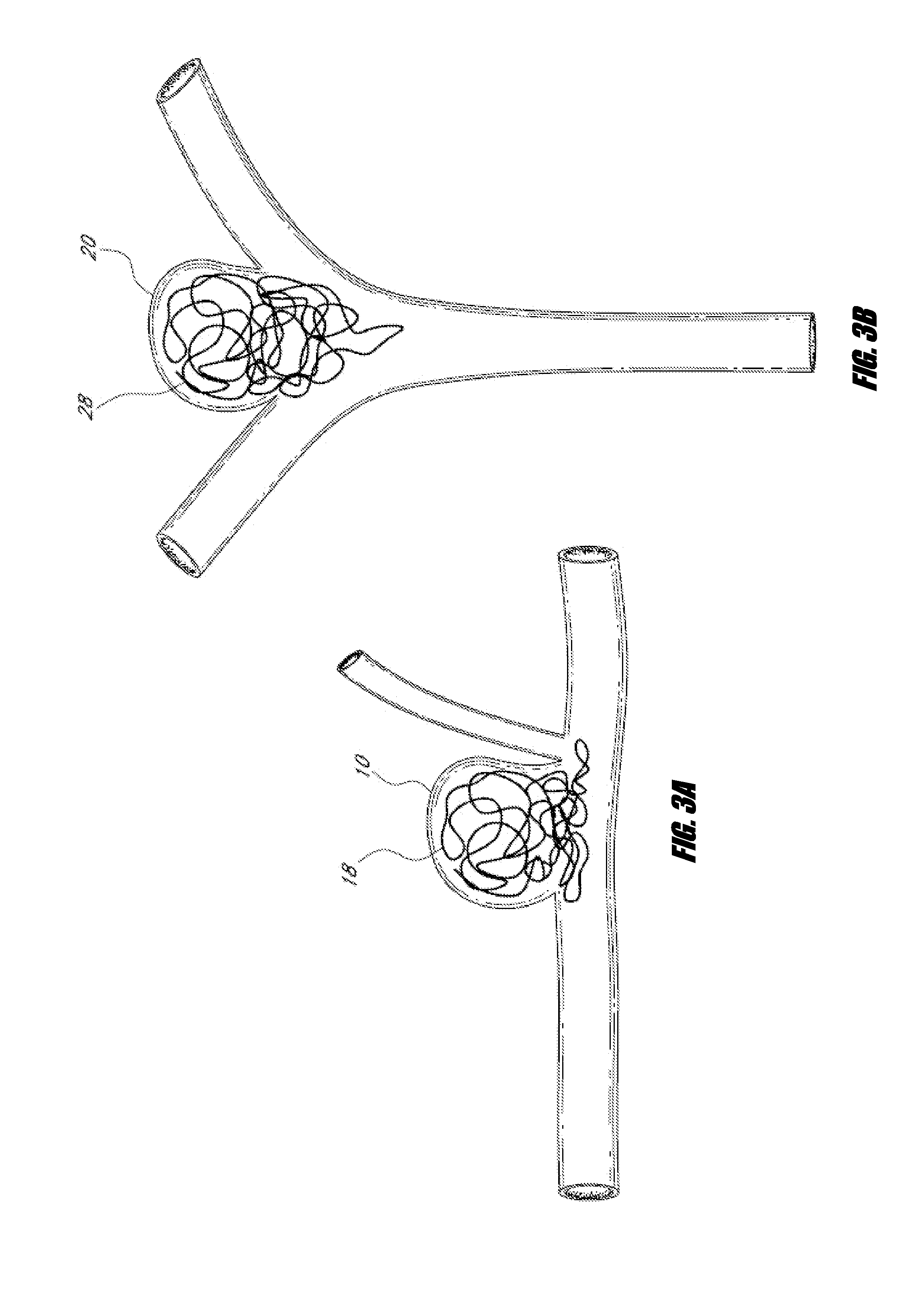 Vascular remodeling device