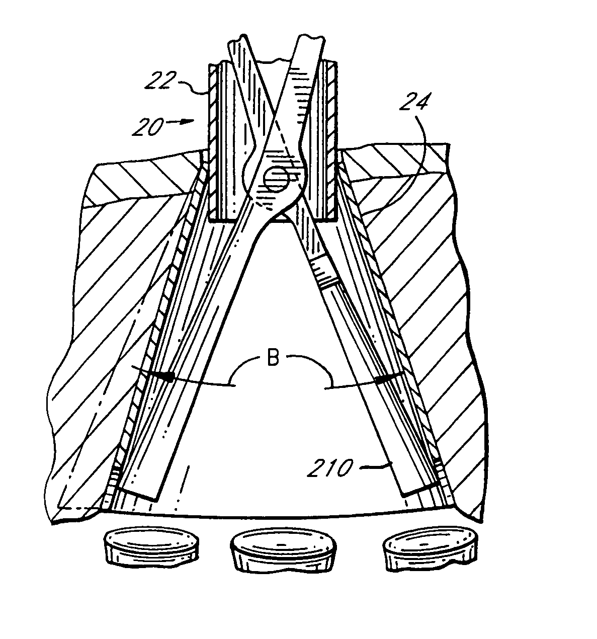 Methods and apparatuses for minimally invasive replacement of intervertebral discs