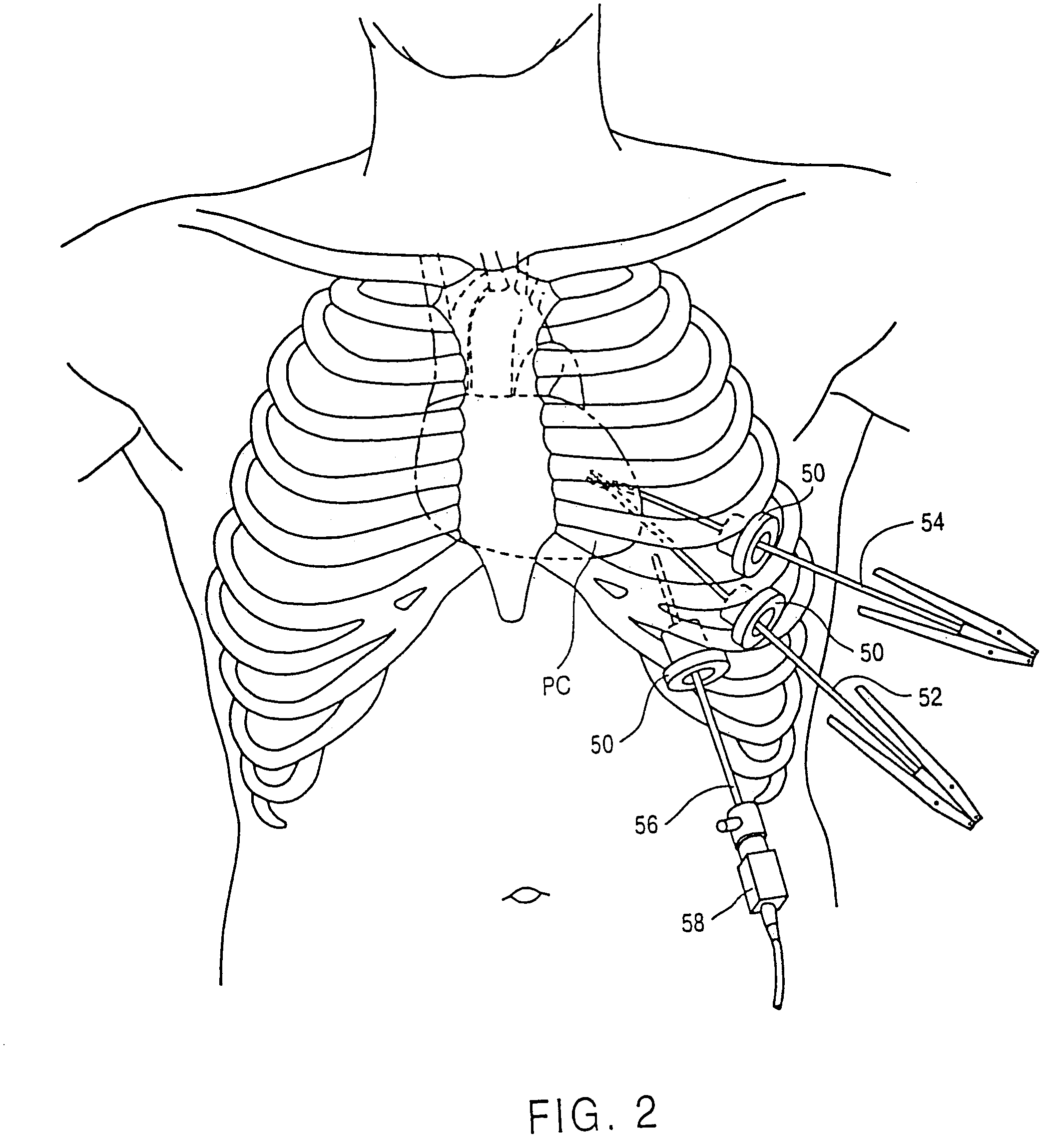 Minimally-invasive devices and methods for treatment of congestive heart failure