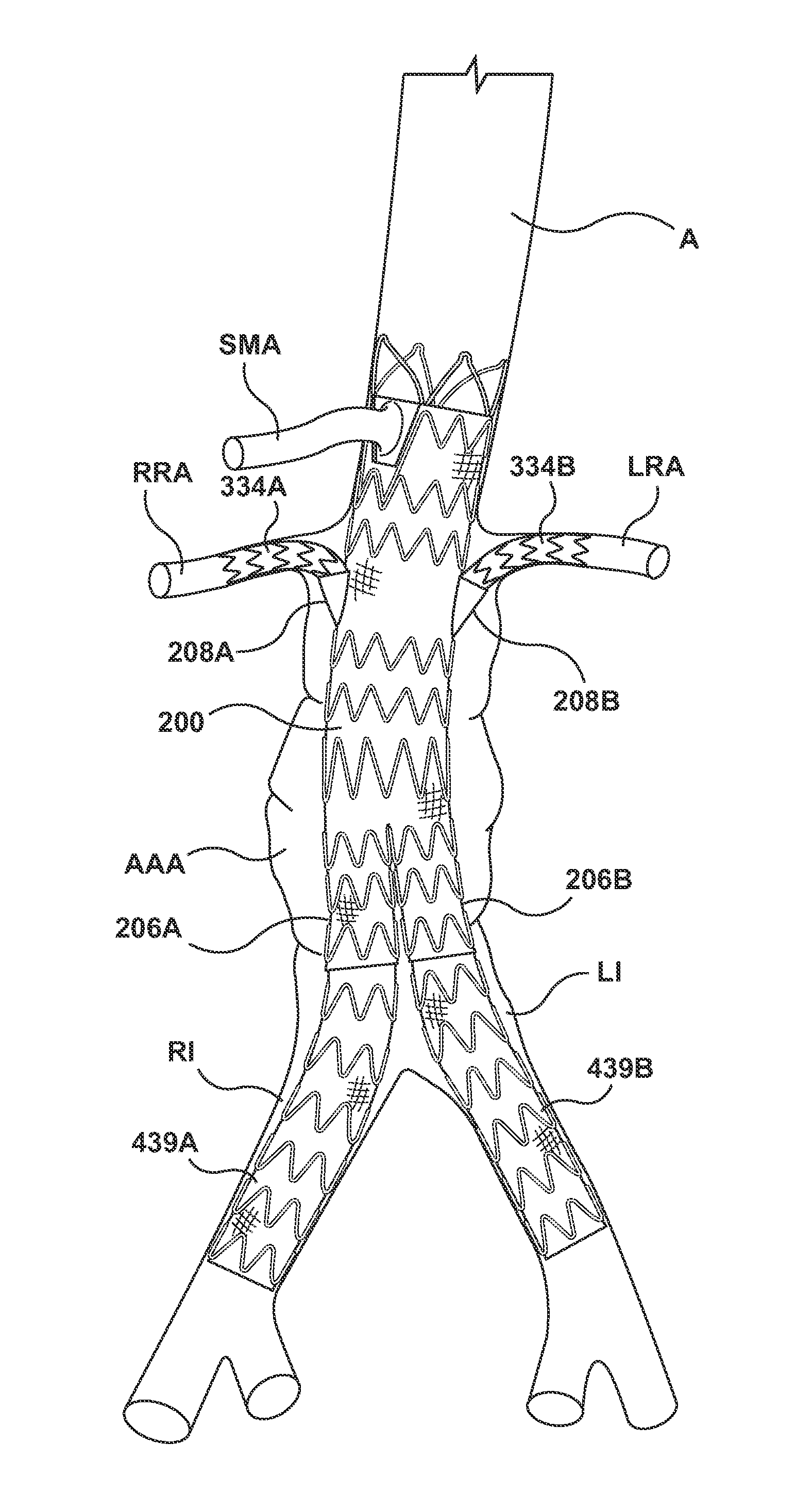 Stent-graft prosthesis for placement in the abdominal aorta