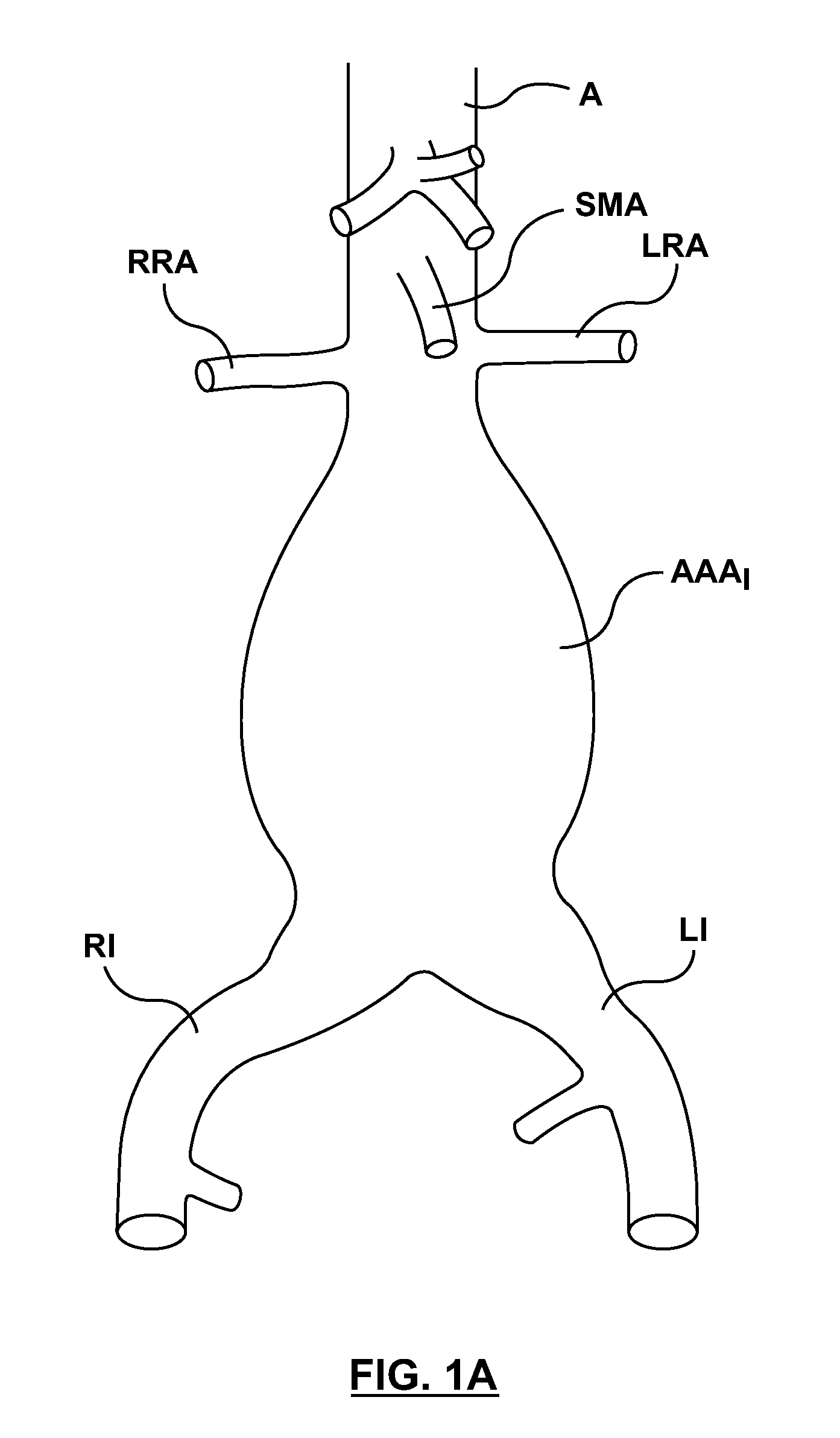 Stent-graft prosthesis for placement in the abdominal aorta