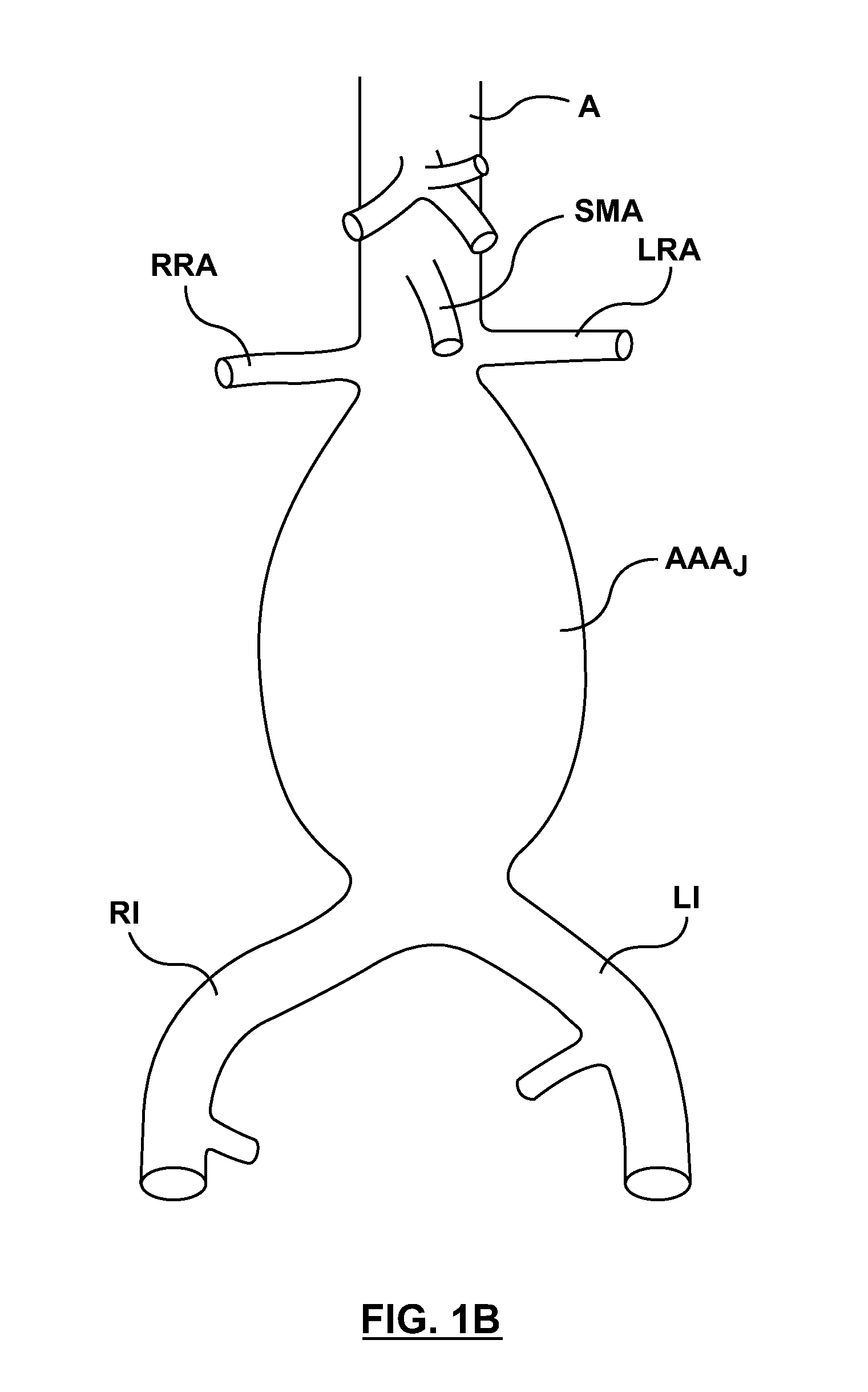 Stent-graft prosthesis for placement in the abdominal aorta