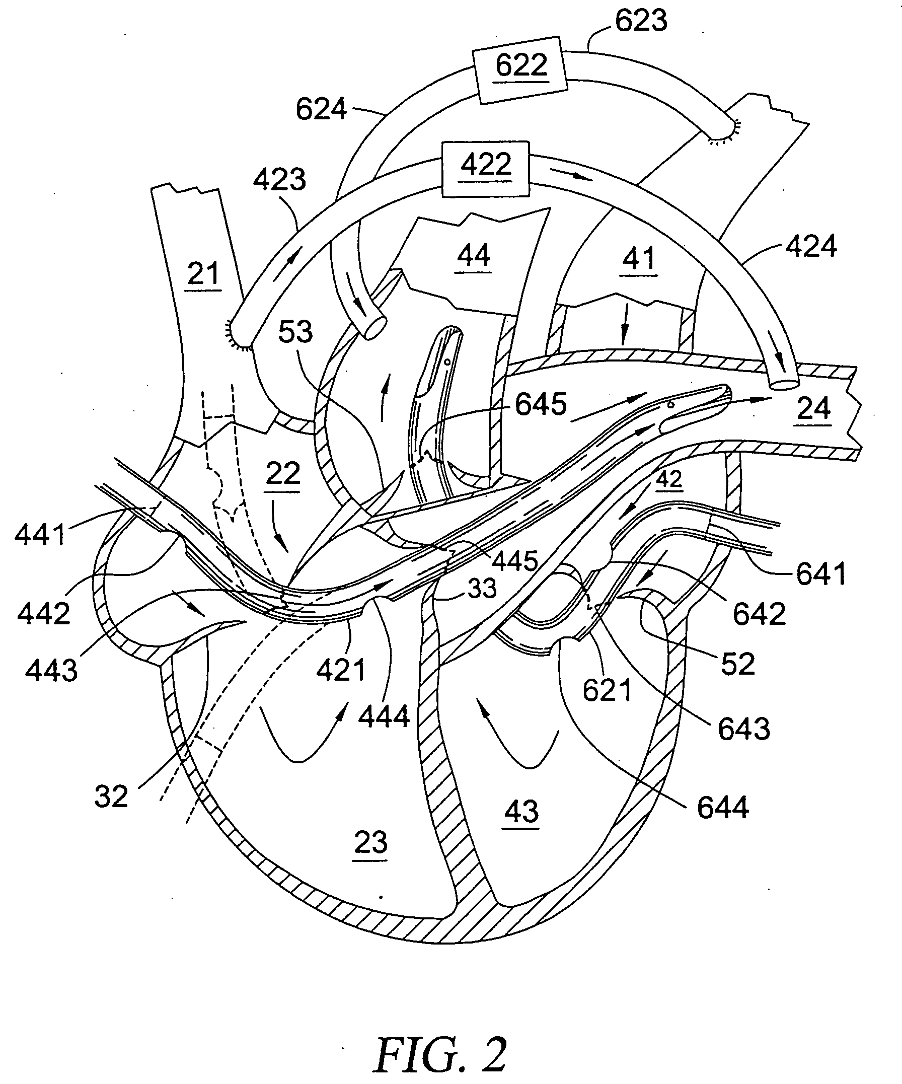 Pulmonary and circulatory blood flow support devices and methods for heart surgery procedures