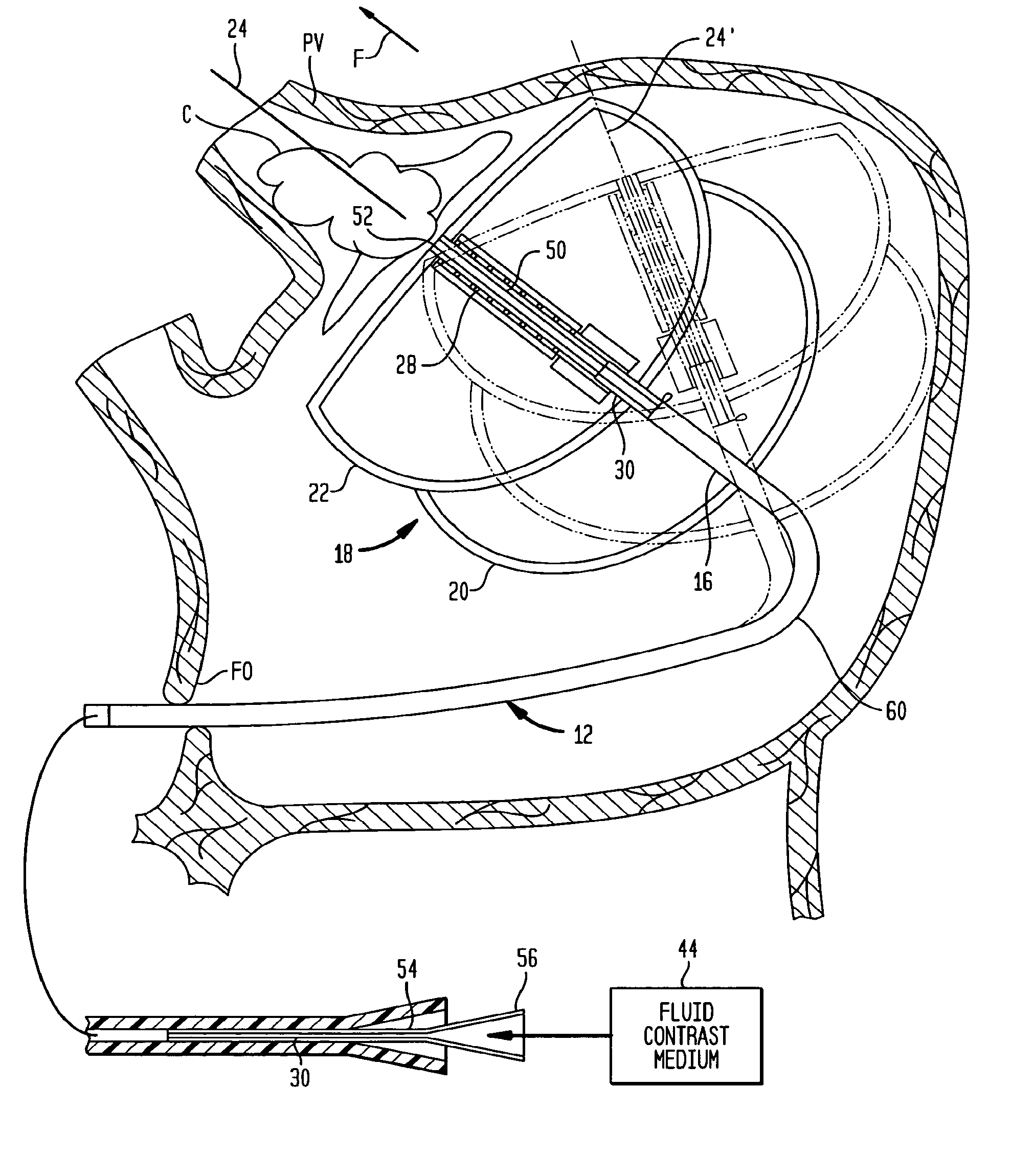 Cardiac ablation devices