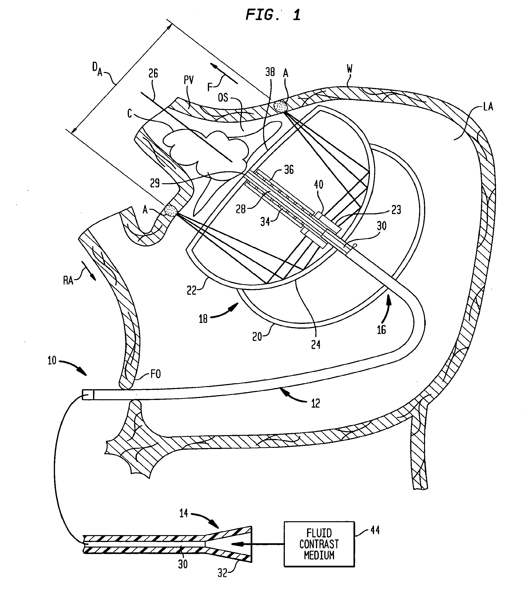 Cardiac ablation devices